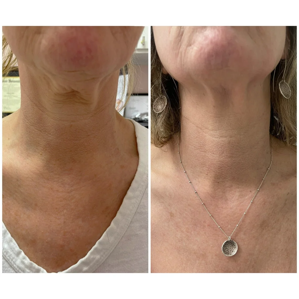 Laser Treatments before-and-after comparison 1