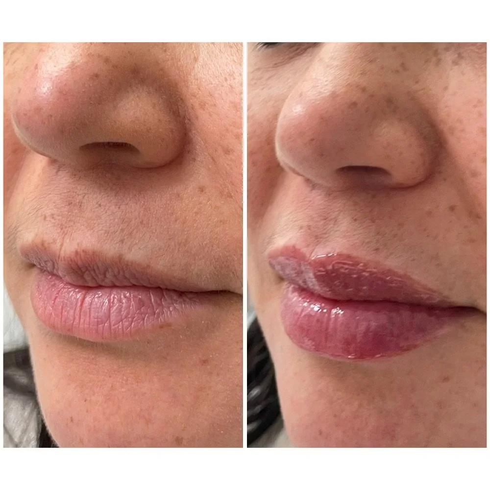 Lip Fillers before-and-after comparison 5