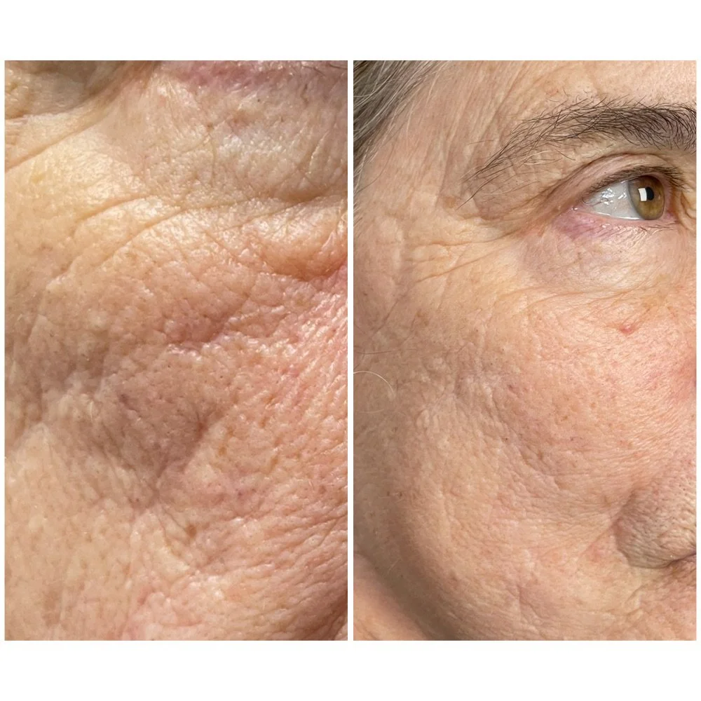 Laser Treatments before-and-after comparison 7
