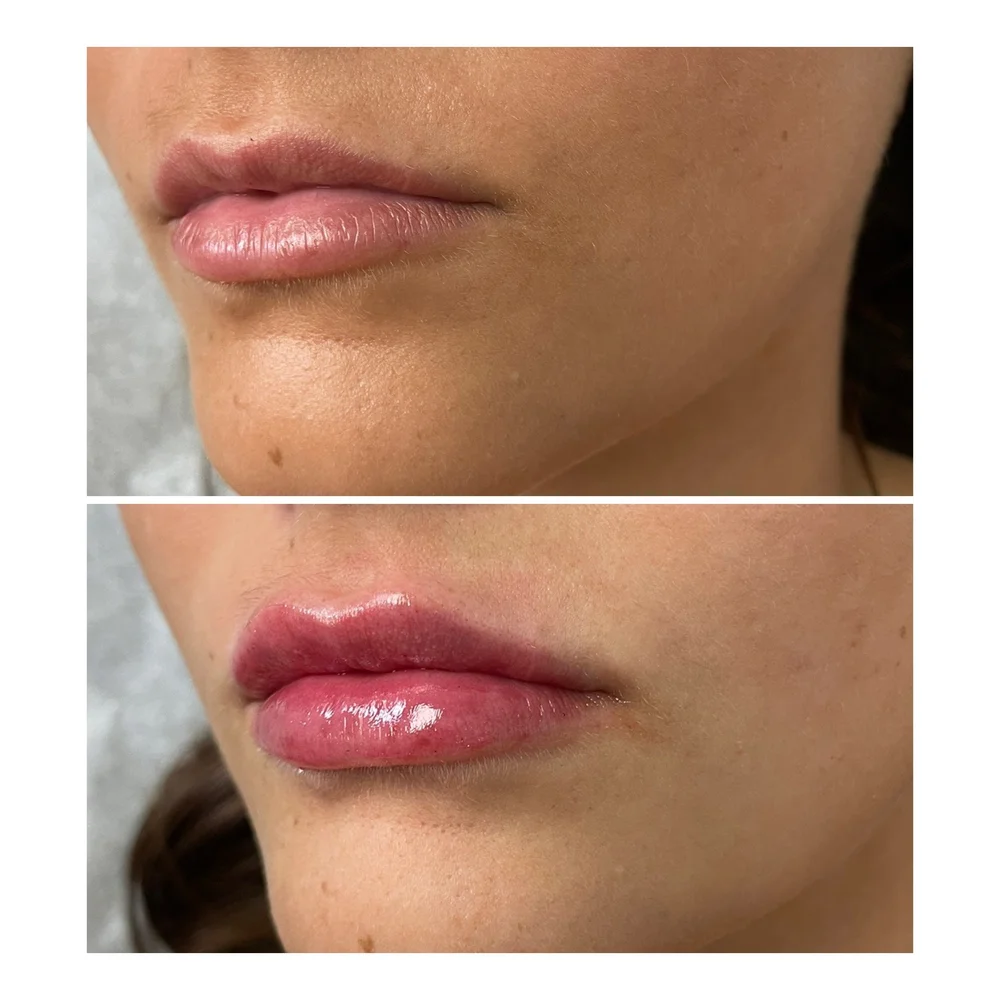 Lip Fillers before-and-after comparison 1
