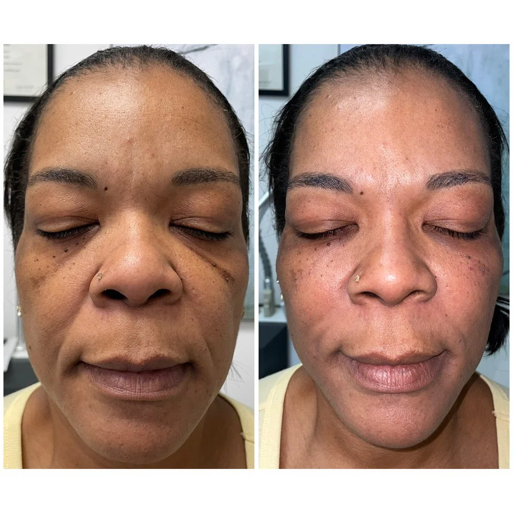 Facial Balancing before-and-after comparison 4