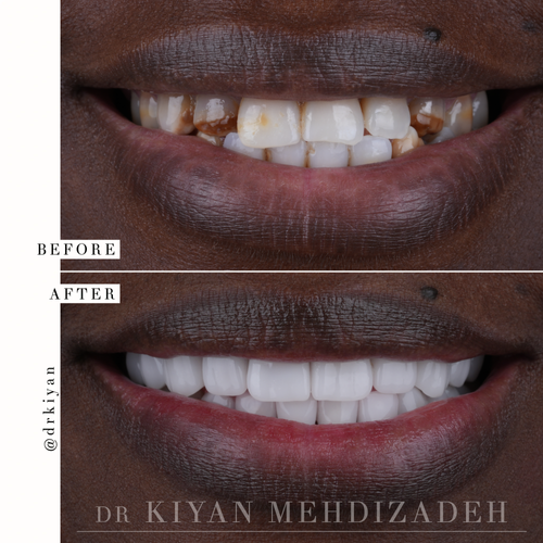 Fluorosis treatment with porcelain veneers and dental implant &mdash; Case Study 16