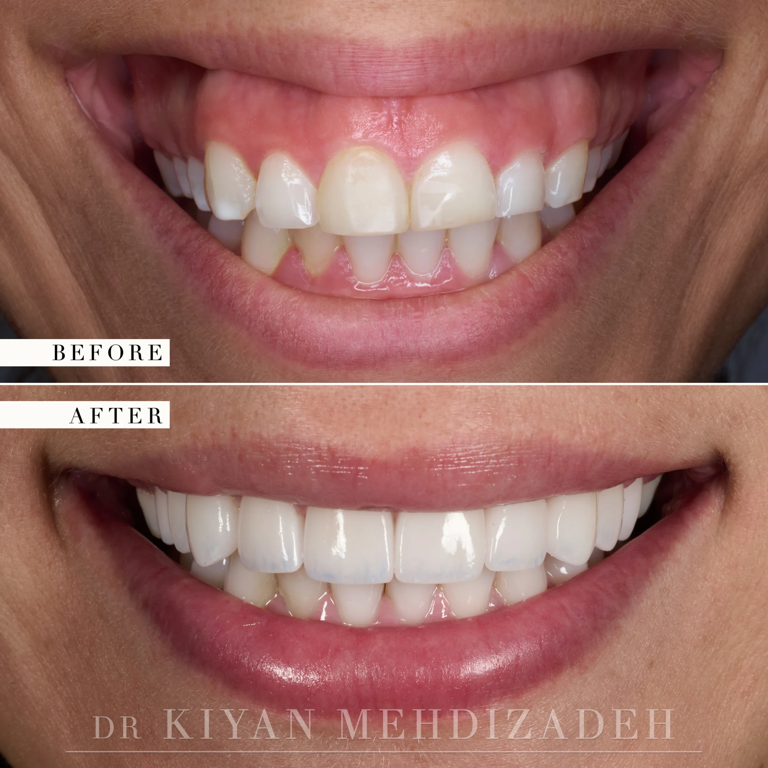 Before and after: gummy smile with a darker central incisor corrected to an even smile, Beverly Hills
