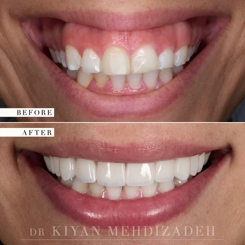 Gummy Smile: Lip Repositioning & Gum Lift before and after - Case Study 29 - Dr. Kiyan Mehdizadeh
