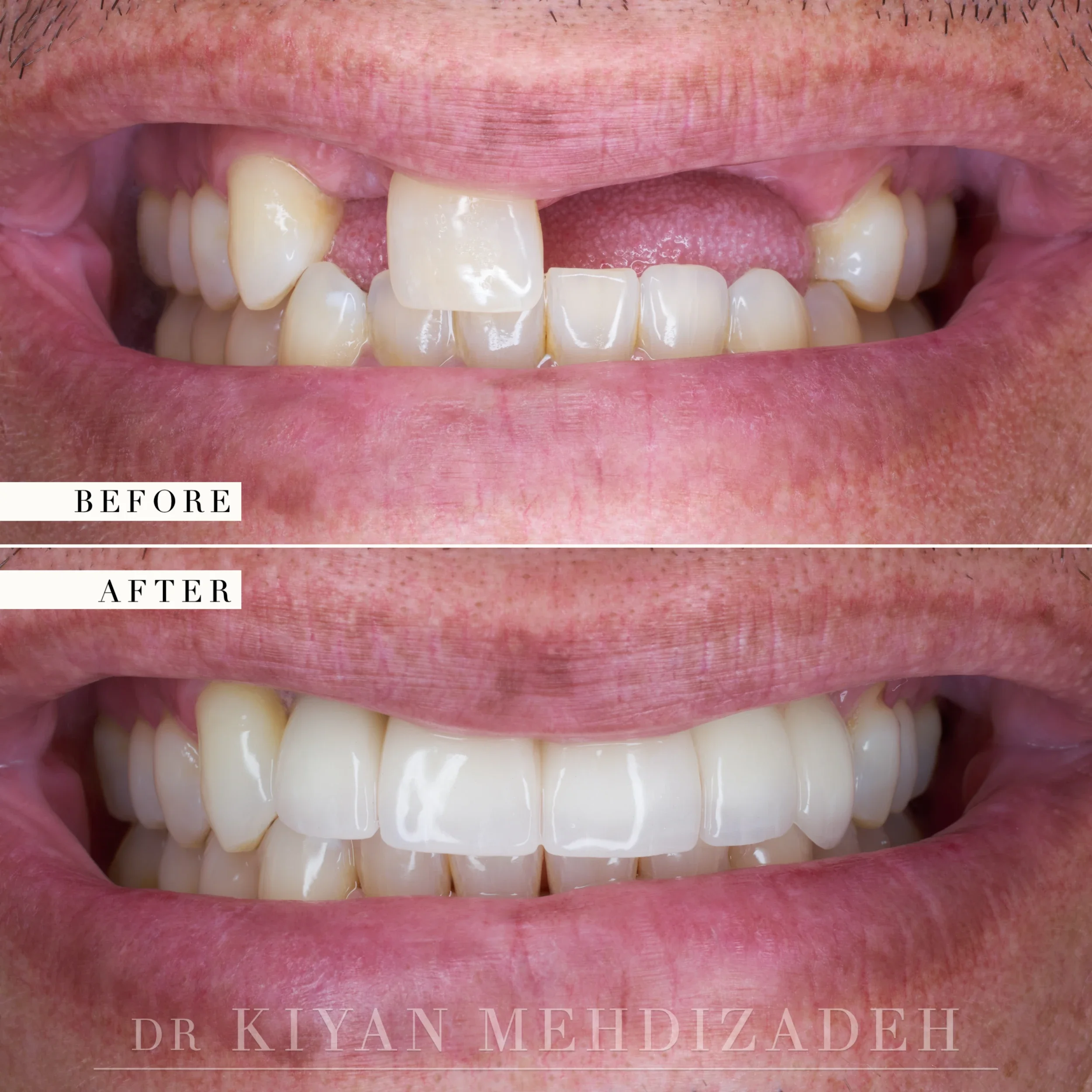 Before and after: four missing upper front teeth restored with bone grafting, three implants, a bridge and a veneer, Beverly Hills