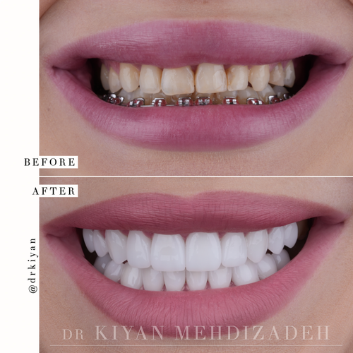 Smile makeover after braces before and after &mdash; Case Study 11