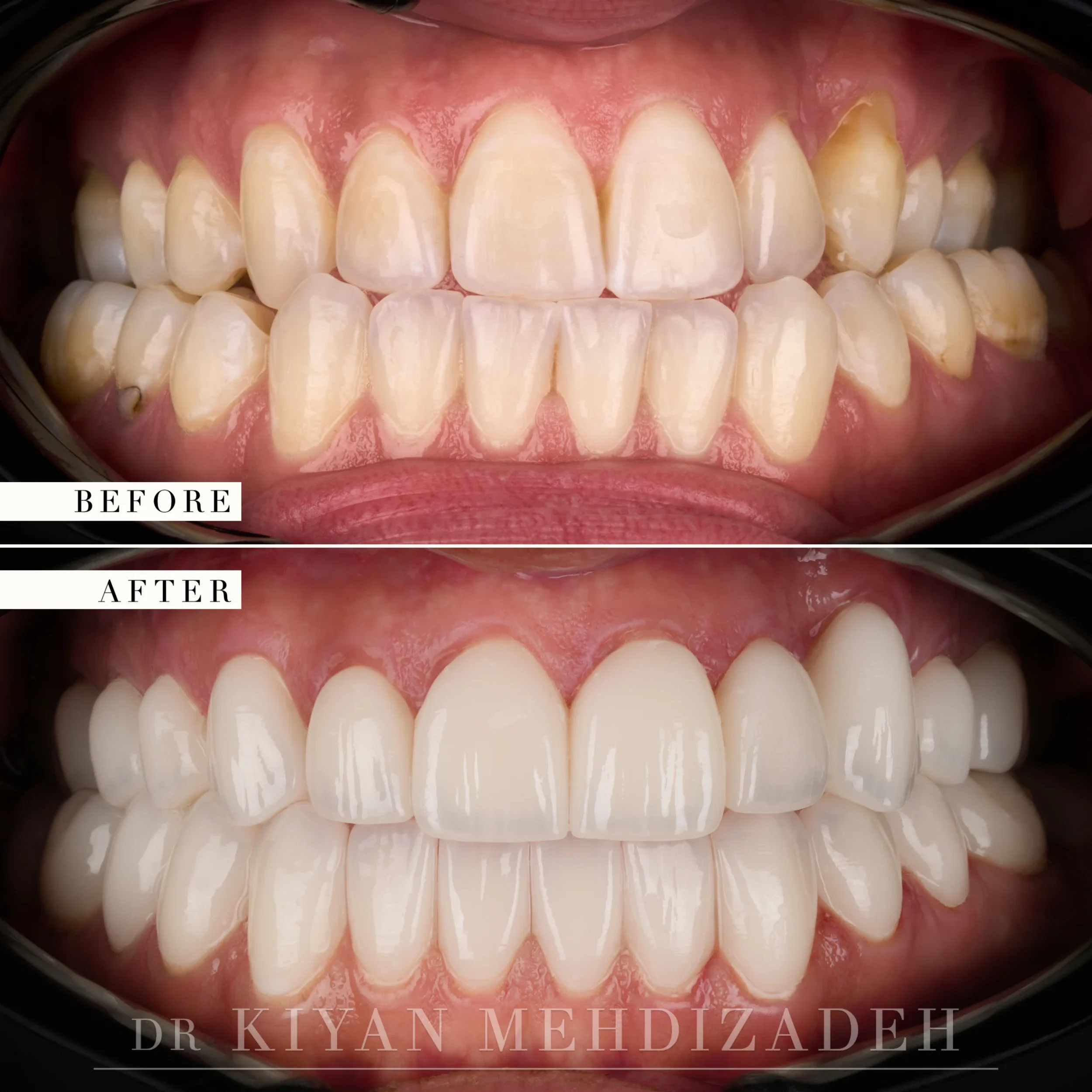 Retracted view after full-mouth veneers corrected an underbite