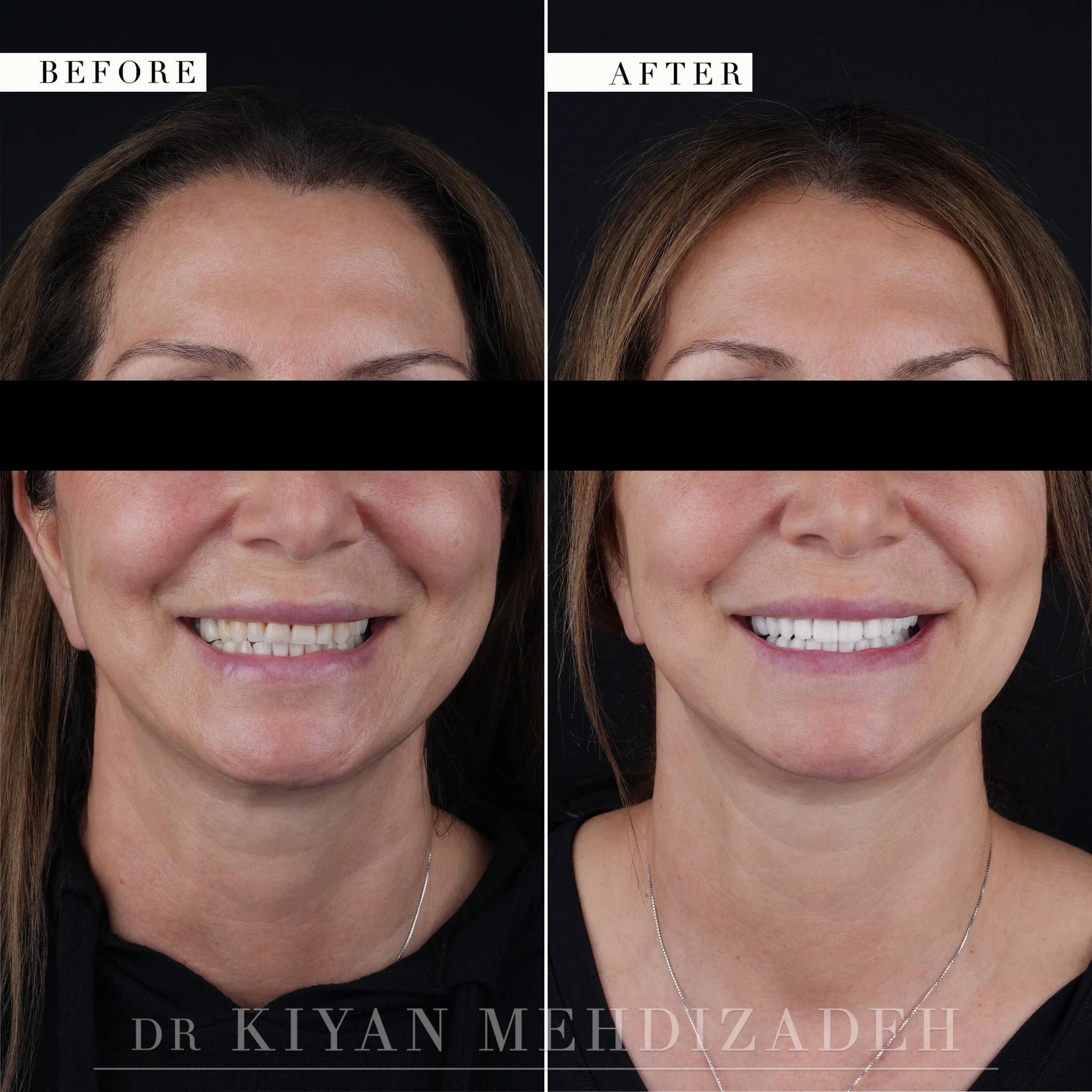 Full face before and after: a shortened, discolored smile restored to fuller length and a brighter shade, Beverly Hills