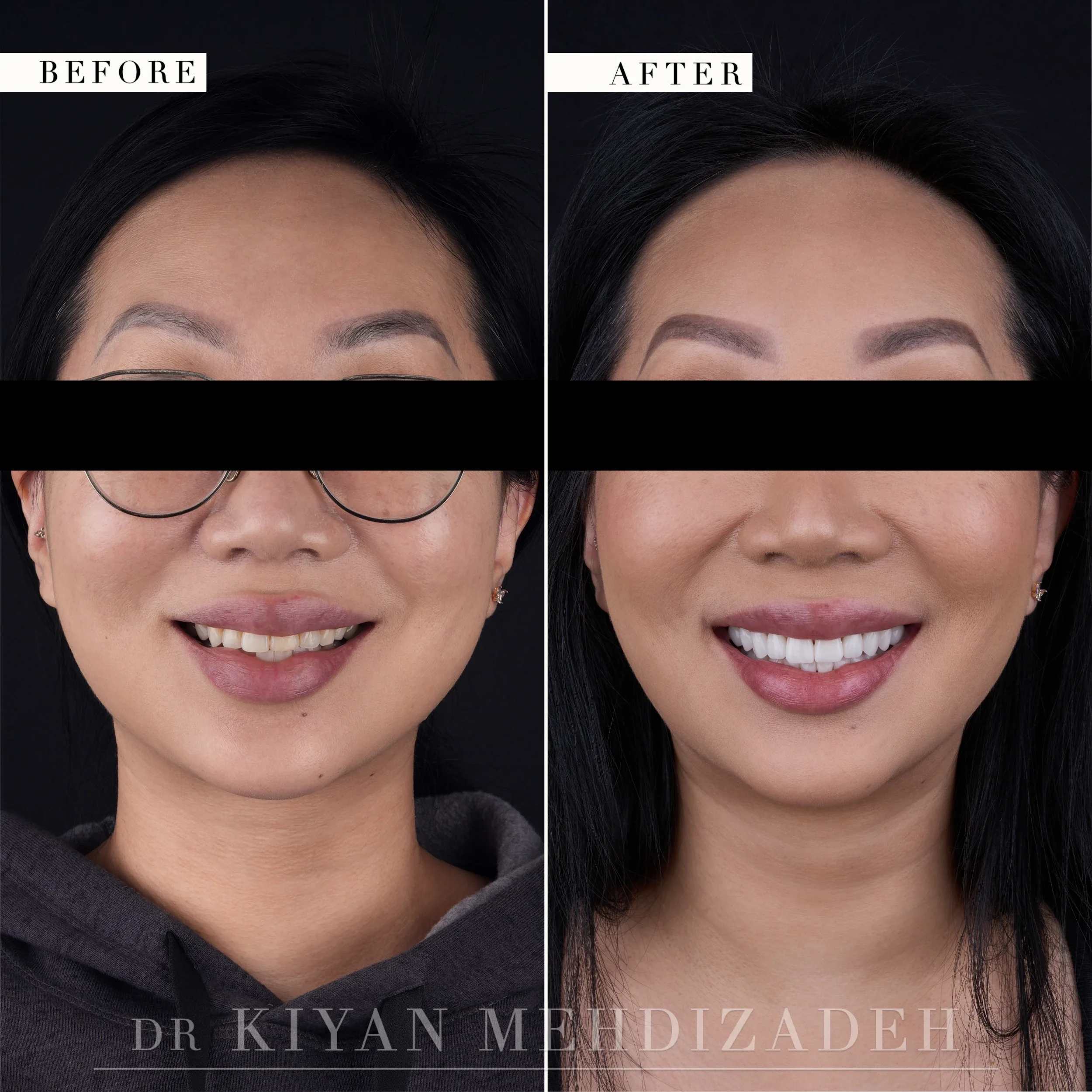 Full face before and after: a narrow smile with small discolored teeth replaced by a broader, brighter smile, Beverly Hills