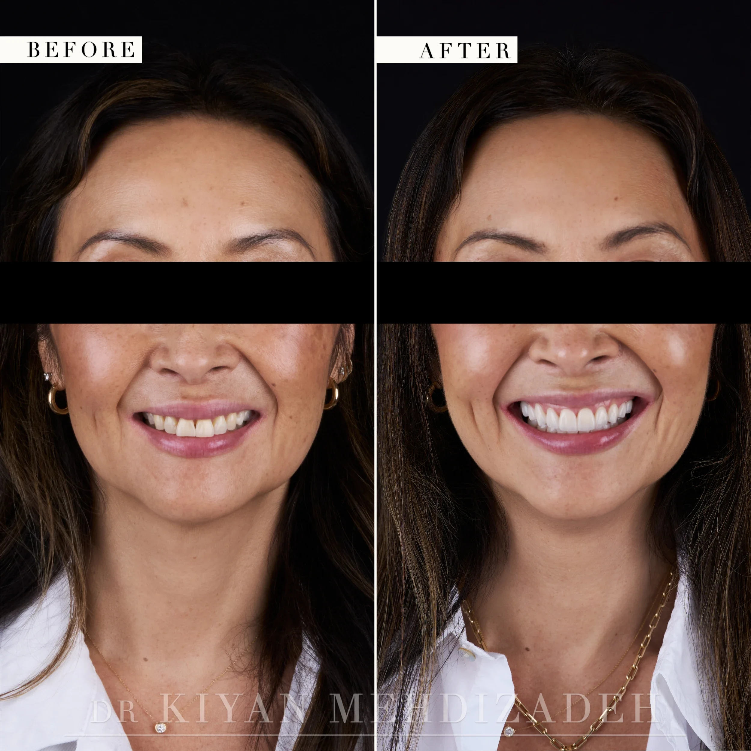 Full-face view after reconstruction with veneers, crowns and implants