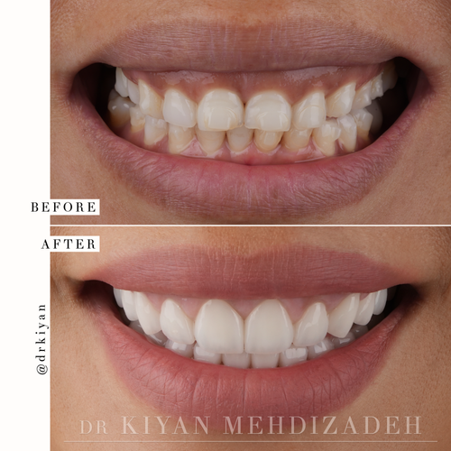 Gum lift and porcelain veneers before and after &mdash; Case Study 01 &mdash; Dr. Kiyan Mehdizadeh