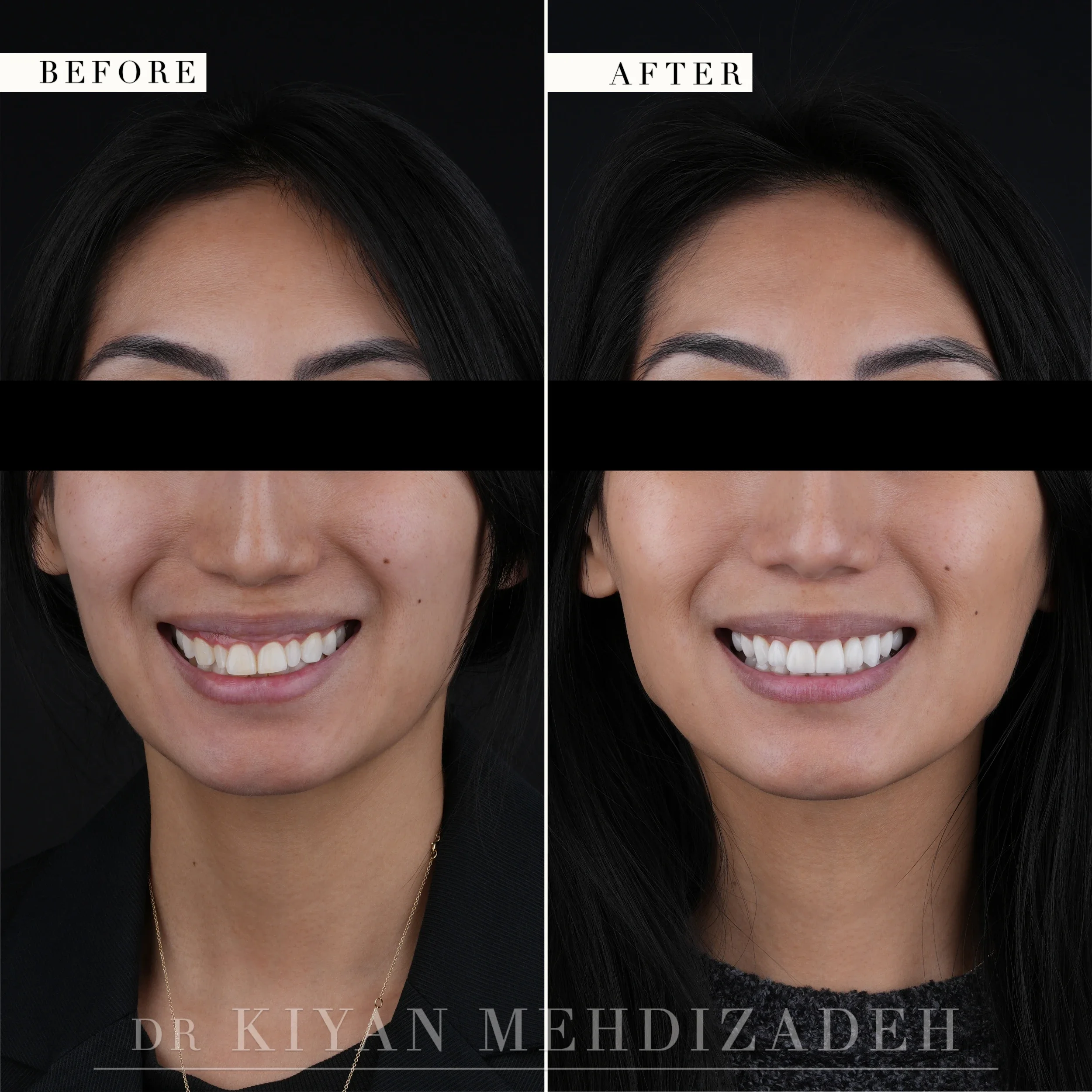 Full face before and after: a narrow, discolored smile replaced by an even, brighter smile in proportion to the face, Beverly Hills