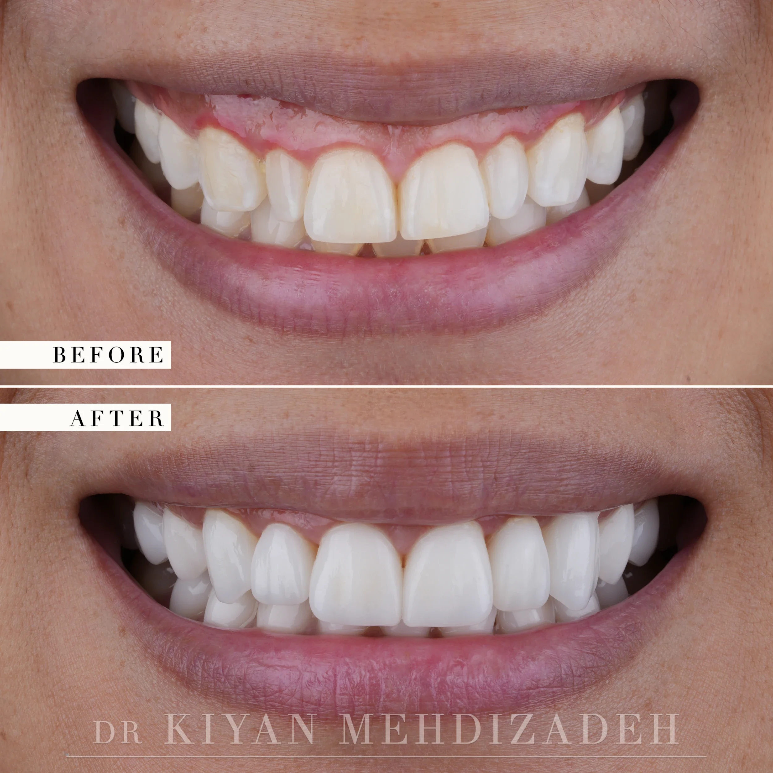 Before and after: an uneven, tilted upper smile line with heavy gum display, corrected to a level line of twenty porcelain veneers, Beverly Hills