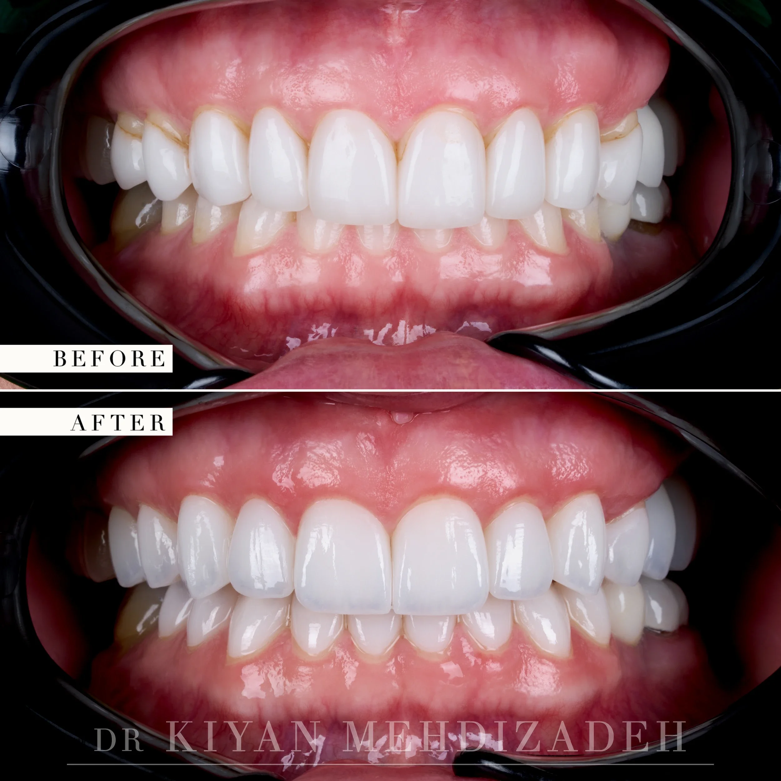Before and after porcelain veneers and implant crowns - retracted view with the teeth together in bite, Beverly Hills