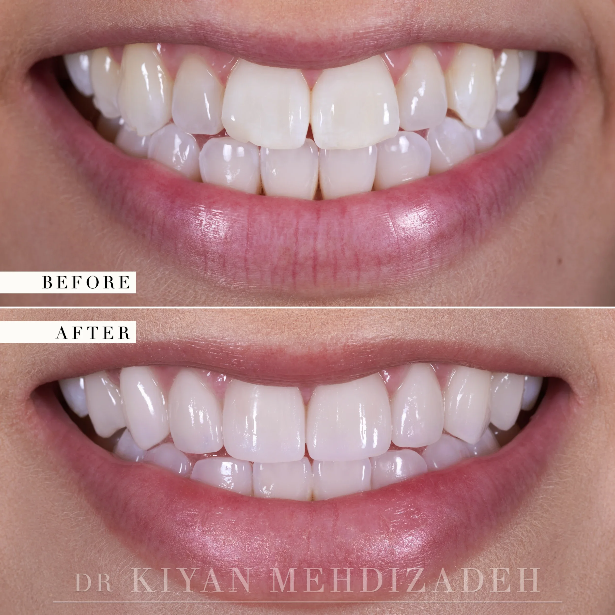 Before and after: brighter upper veneers with whitened natural lower teeth, Beverly Hills