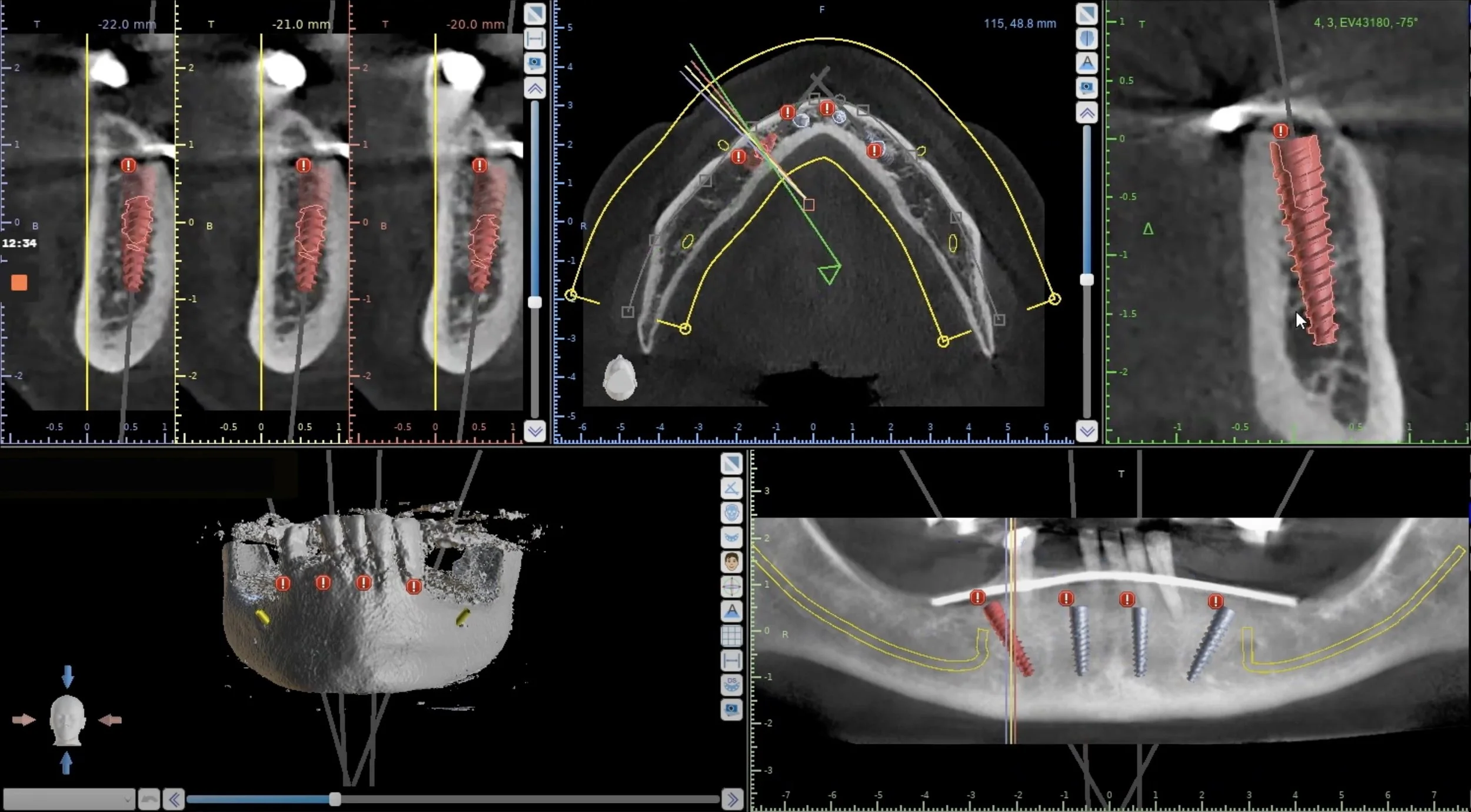 3D Implant Planning Technology