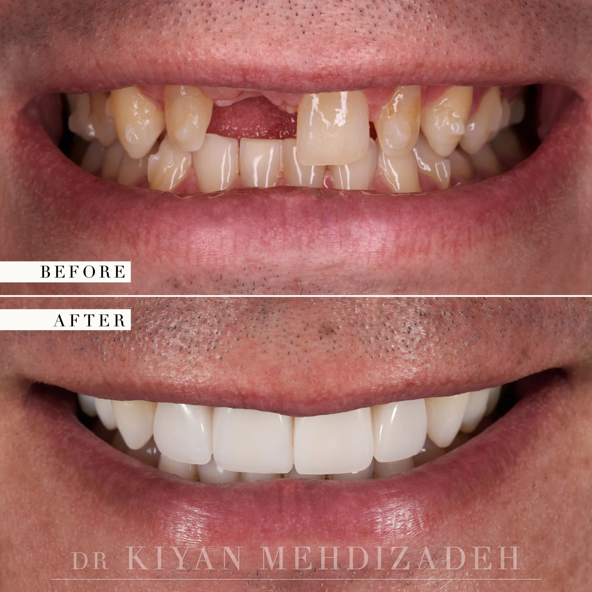 Before and after: a missing upper central incisor and undersized lateral incisors restored with an implant crown and three veneers, Beverly Hills