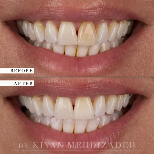 Discolored Tooth: Internal Bleaching before and after - Case Study 23 - Dr. Kiyan Mehdizadeh