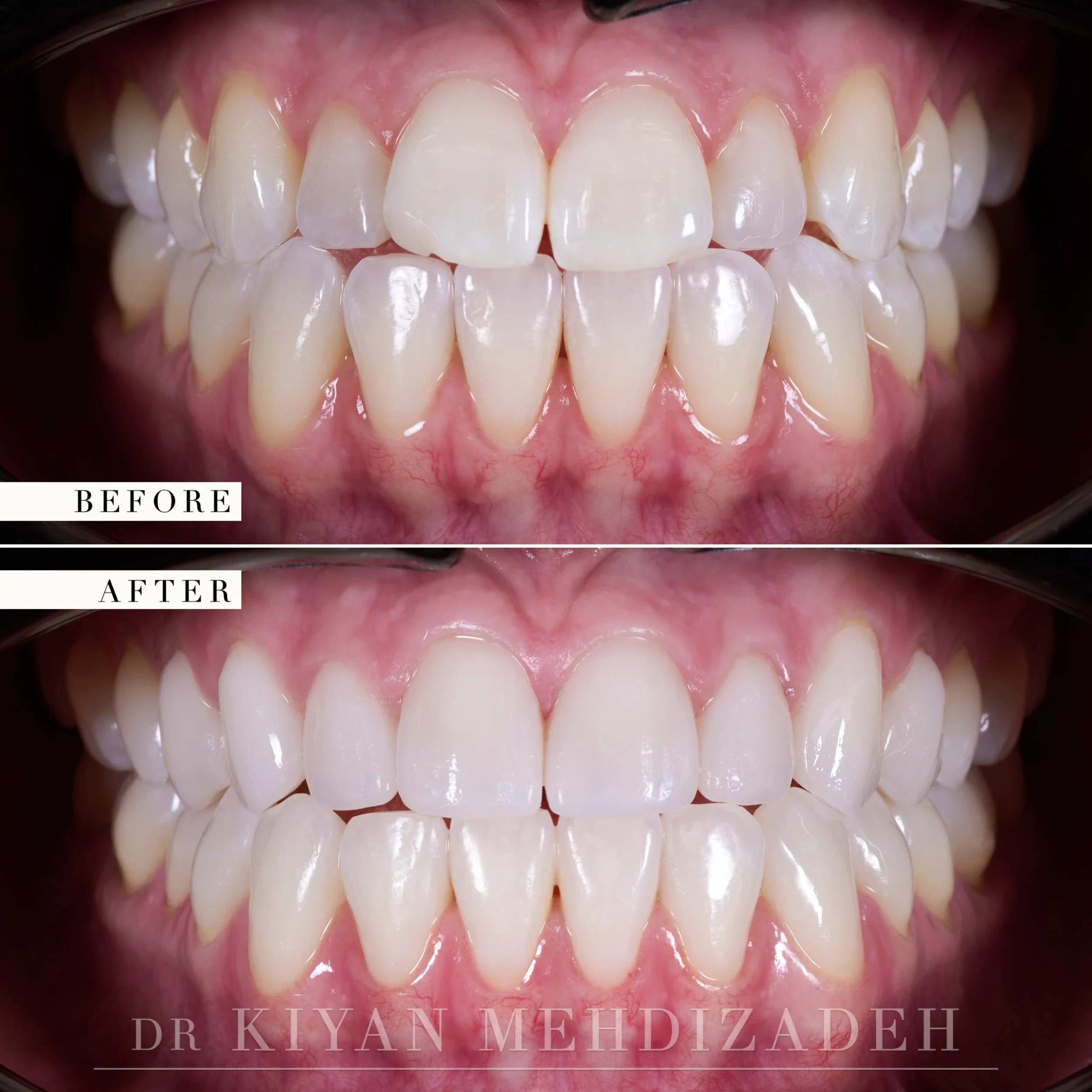 Retracted view of both arches in occlusion, before and after
