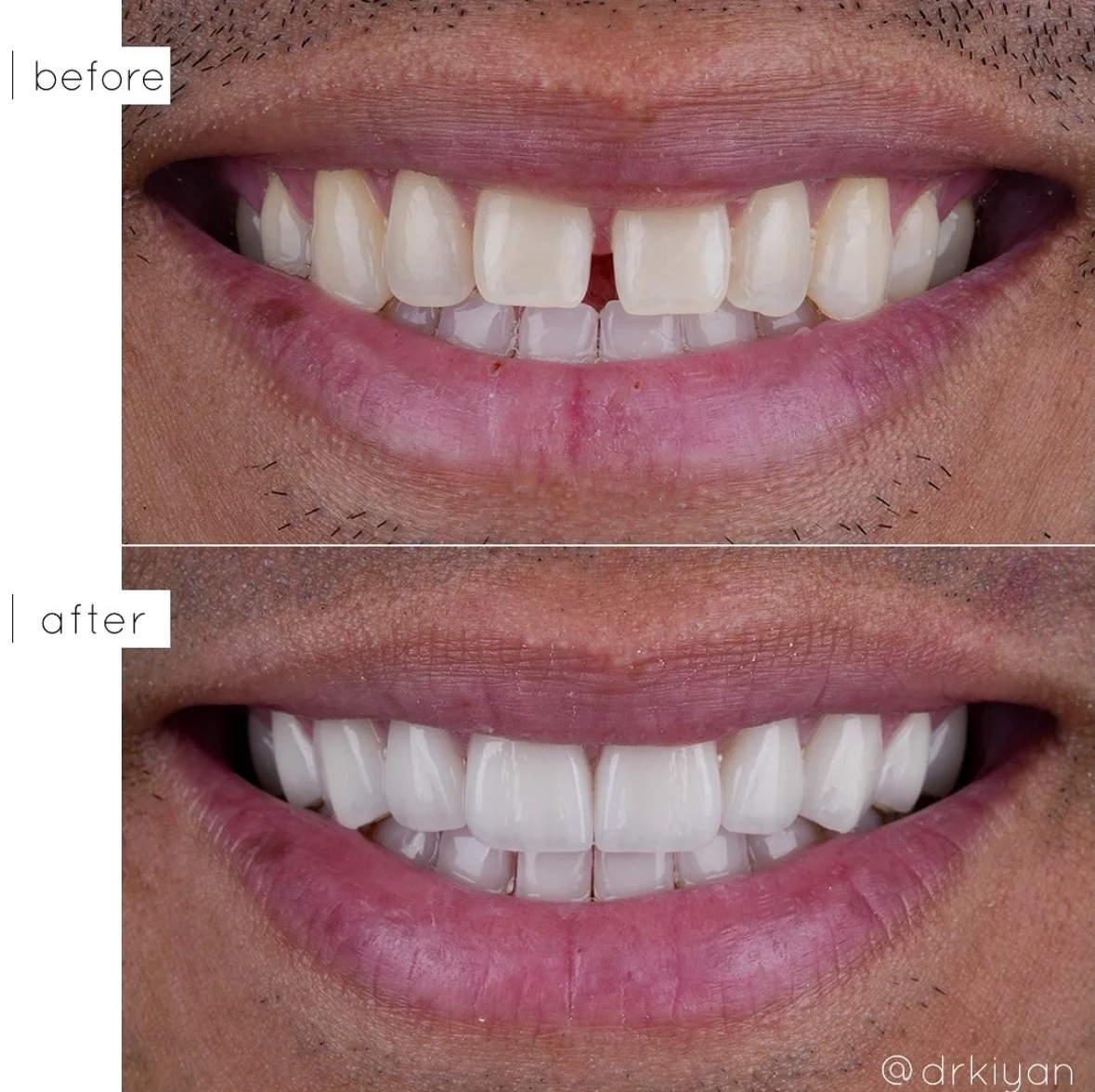 Porcelain Veneers Before and After