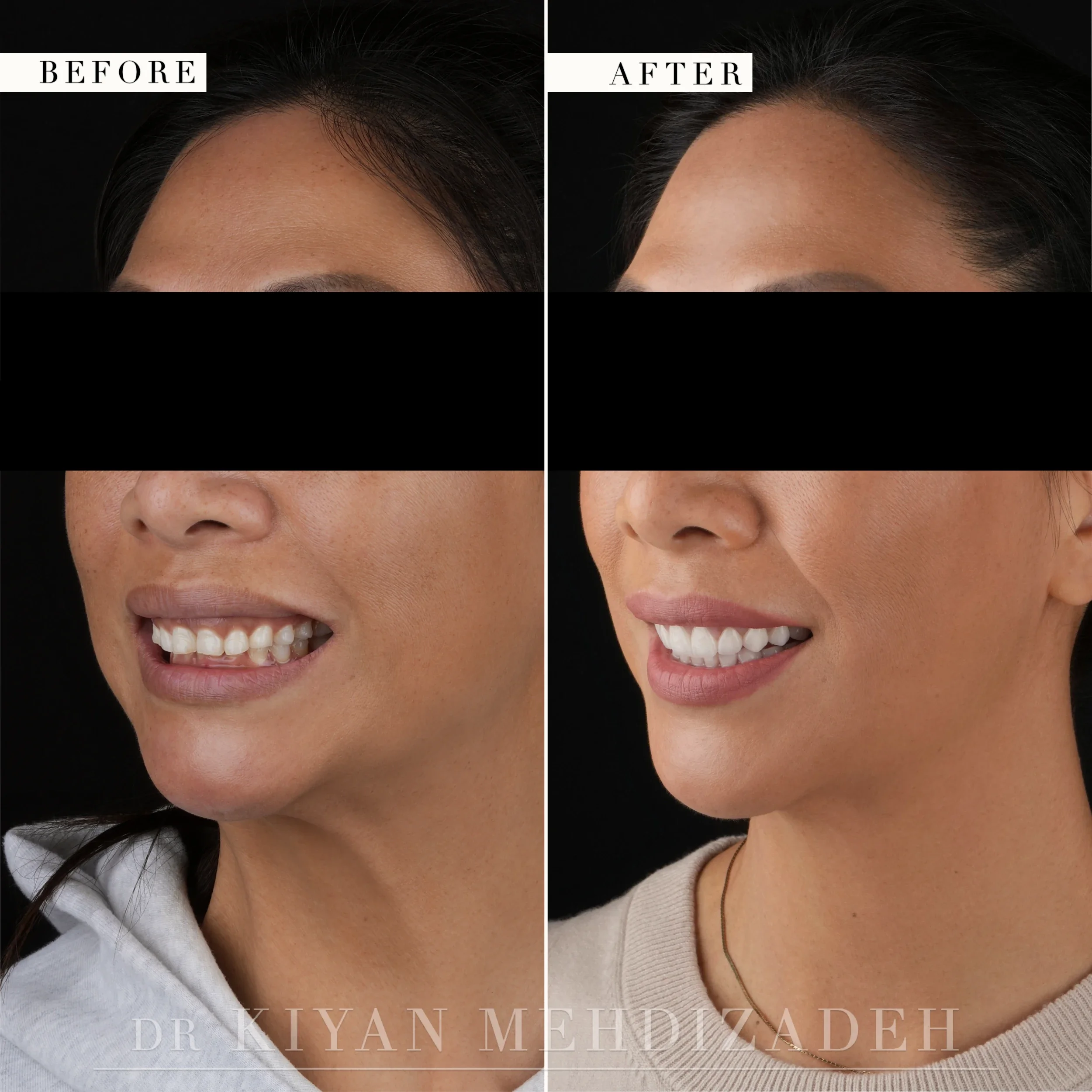 Three-quarter portraits before and after smile makeover with gum lift and porcelain veneers following Invisalign