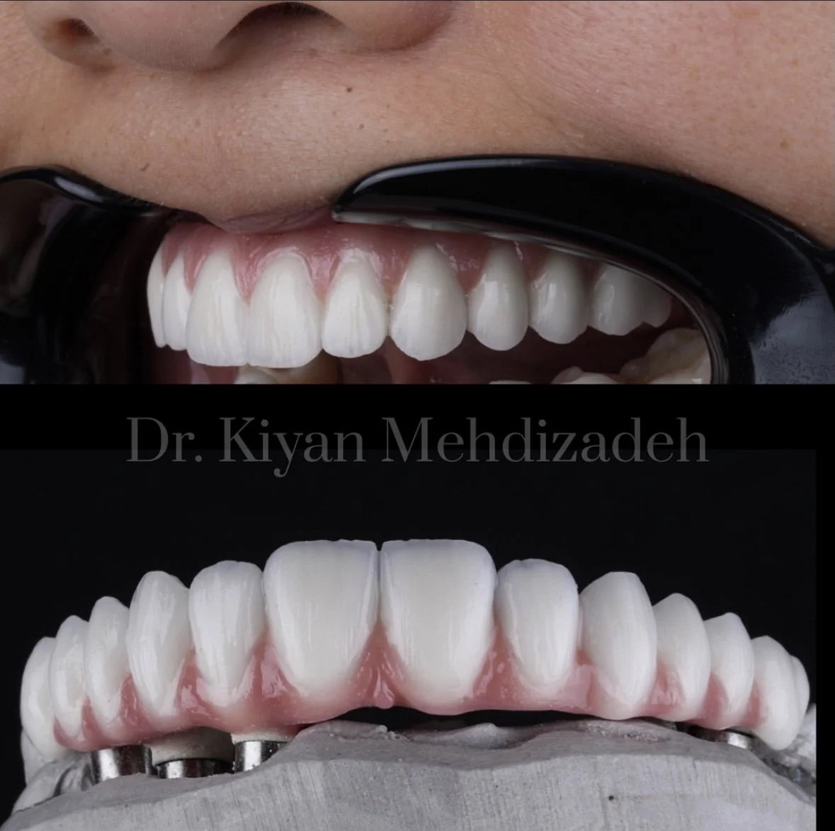 Finished full-arch prosthesis seated on implant abutments