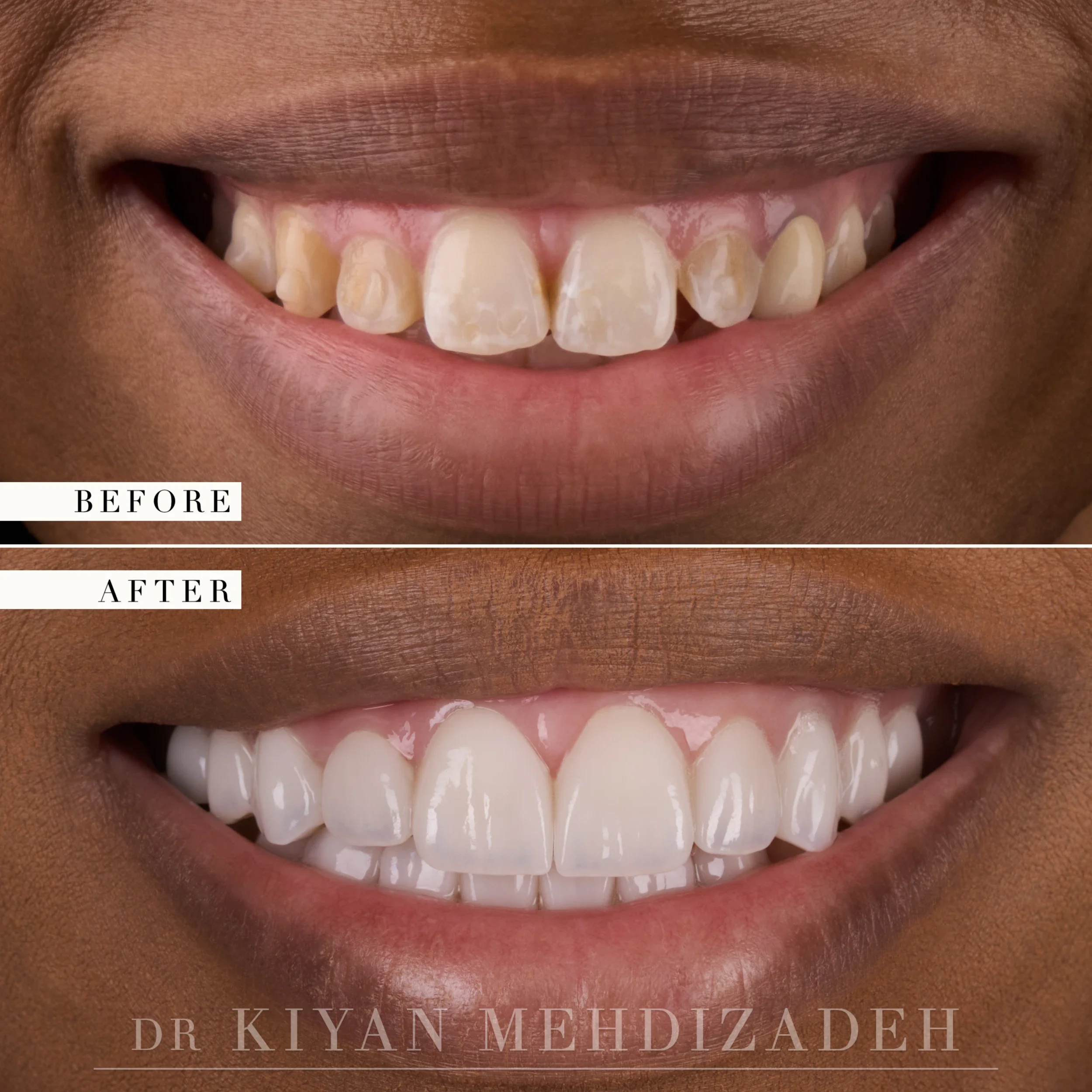 Flared, discolored teeth corrected with veneers, before and after, Beverly Hills