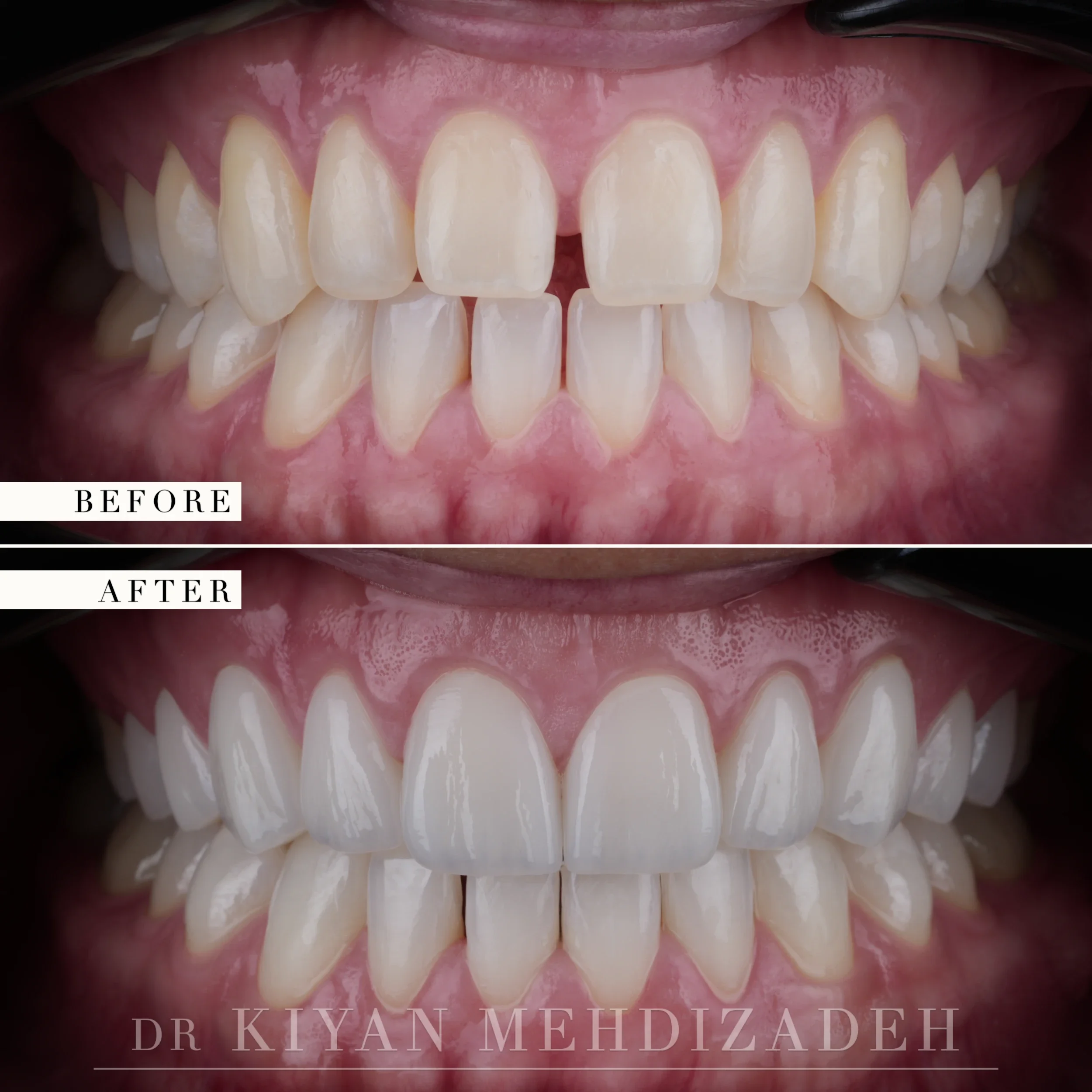 Before and after retracted view showing the midline diastema and the final porcelain veneers