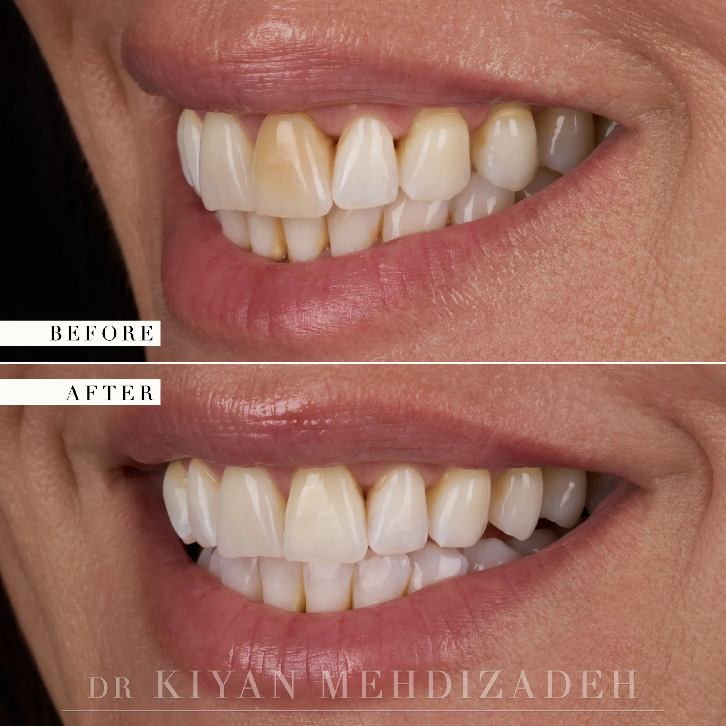 Lateral view after internal bleaching of a discolored front tooth