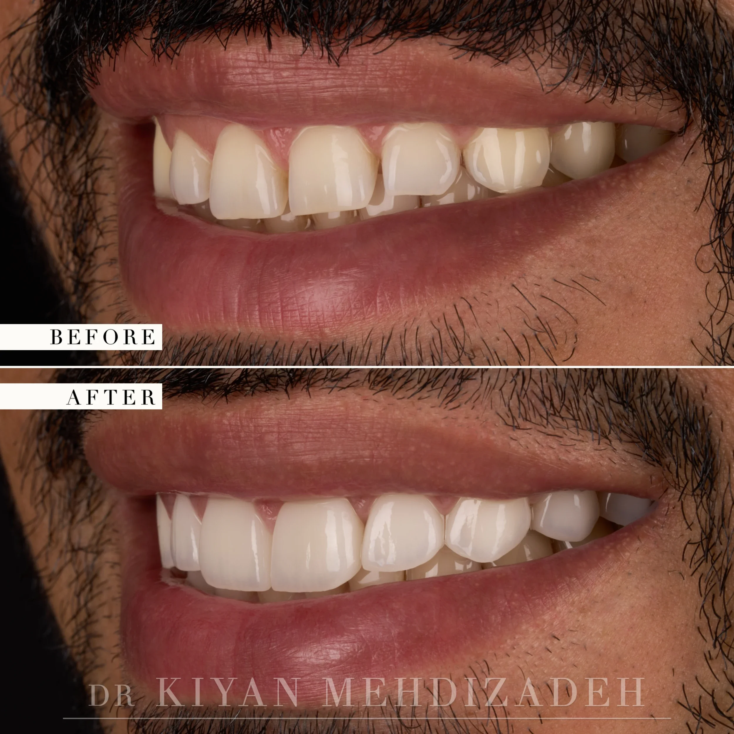 Right lateral view after crown lengthening and veneers