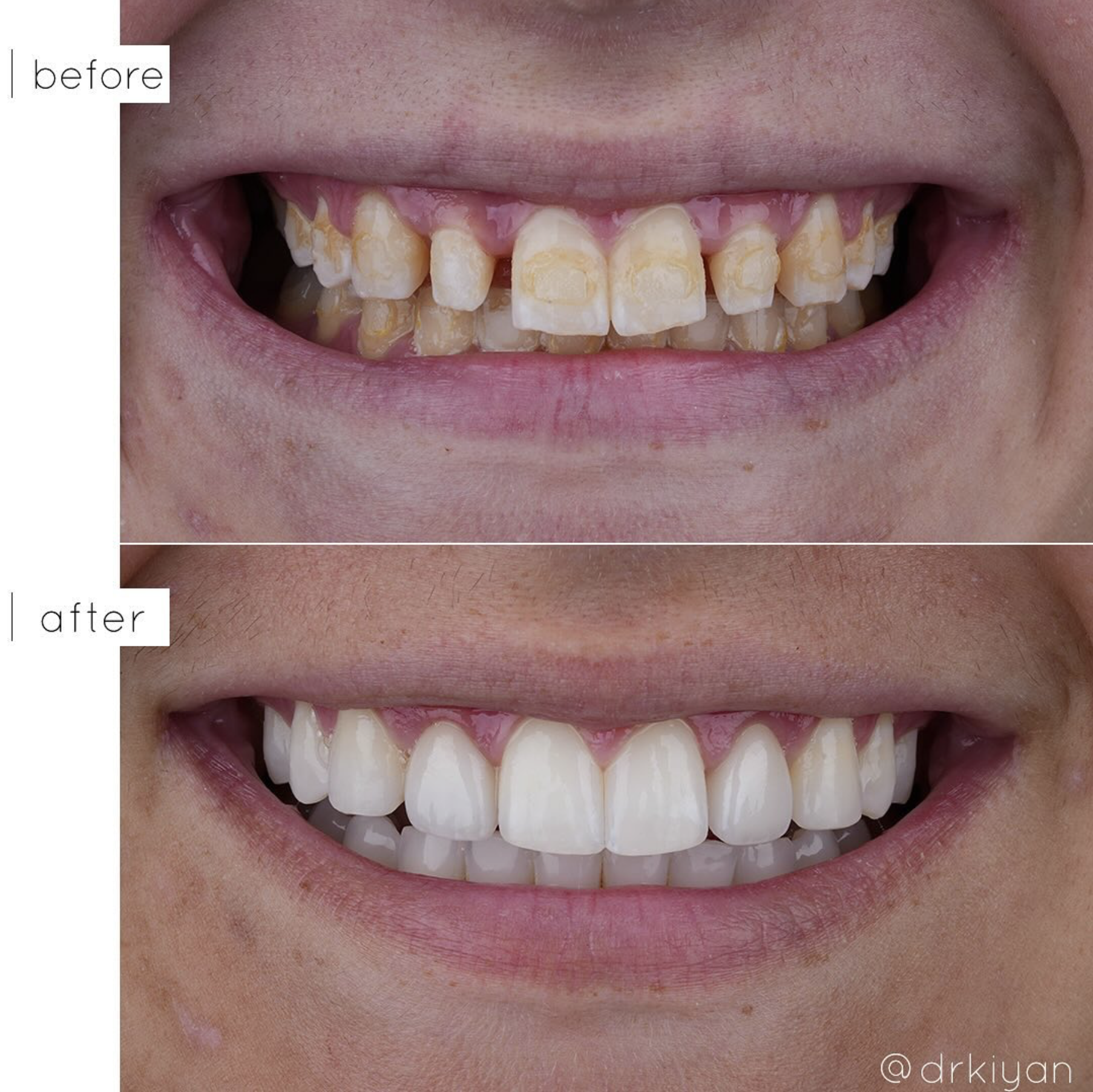Before and After Peg Lateral Veneers - View 2 - Dr. Kiyan Mehdizadeh Beverly Hills