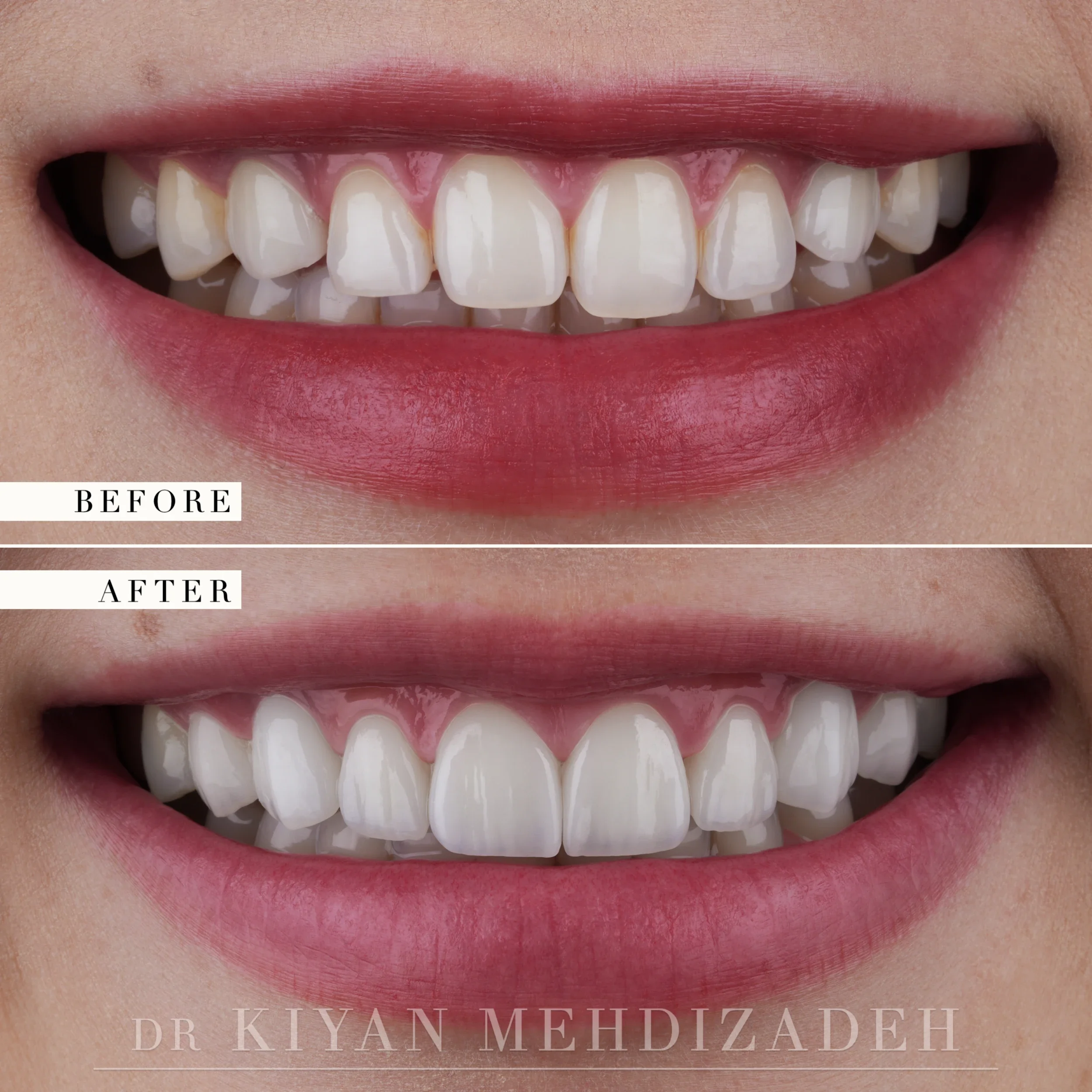 Before and after gum lift and porcelain veneers - frontal close-up smile