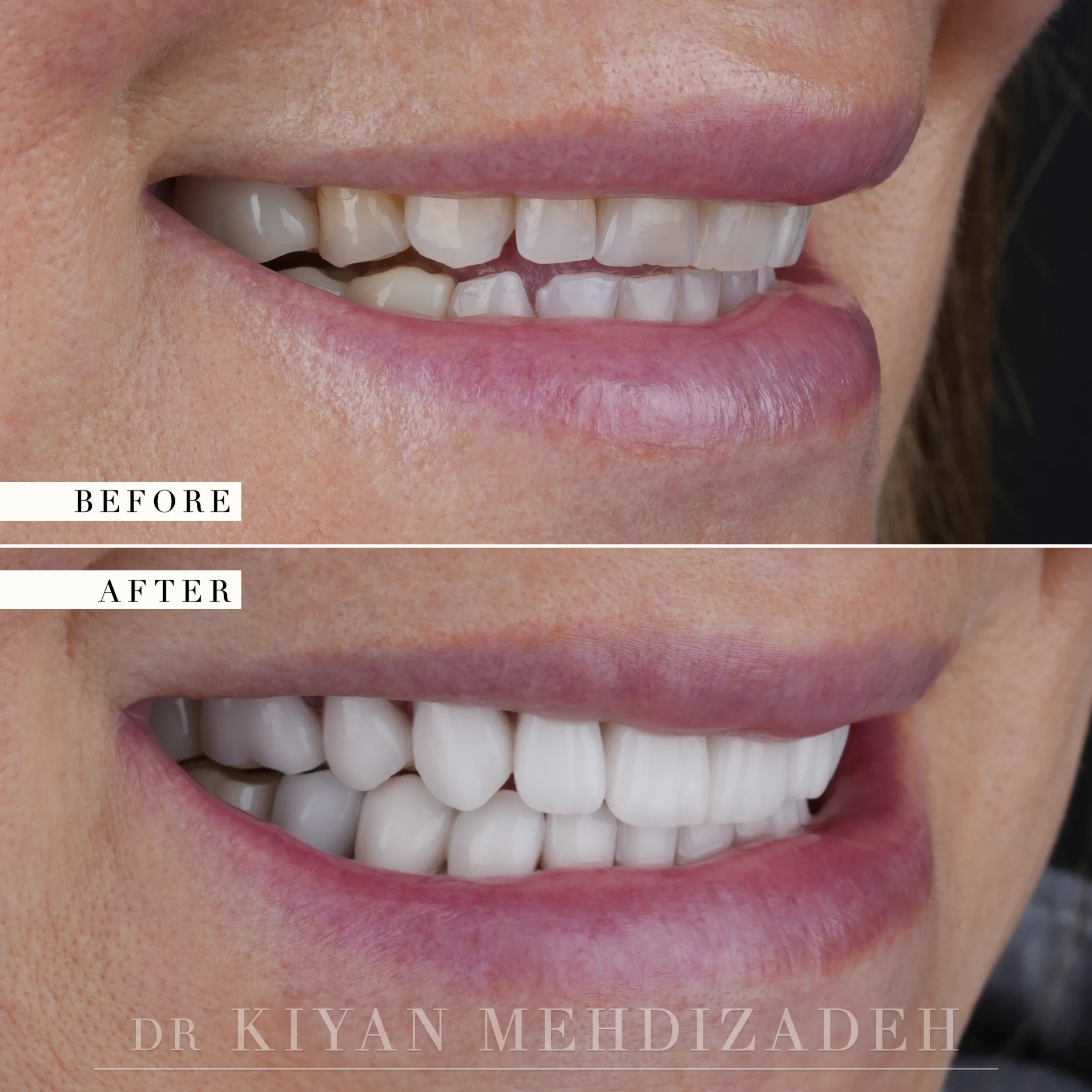 Right side before and after: short, worn teeth with a dark buccal corridor restored to a lengthened, brighter veneered arch, Beverly Hills