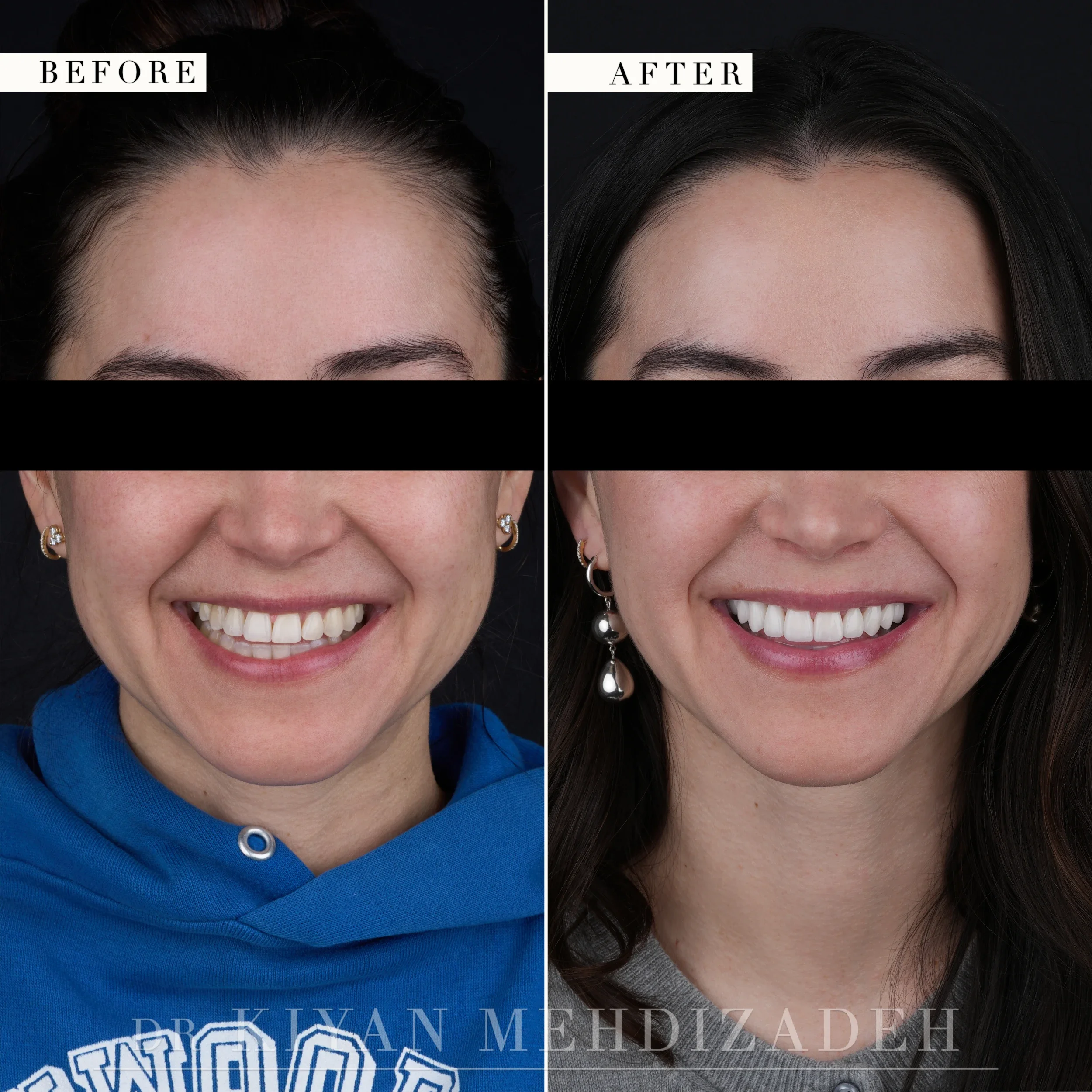 Full face before and after: a discolored, uneven smile replaced by a brighter, centered smile, Beverly Hills