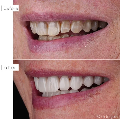 Tetracycline staining correction with porcelain veneers before and after &mdash; Case Study 09