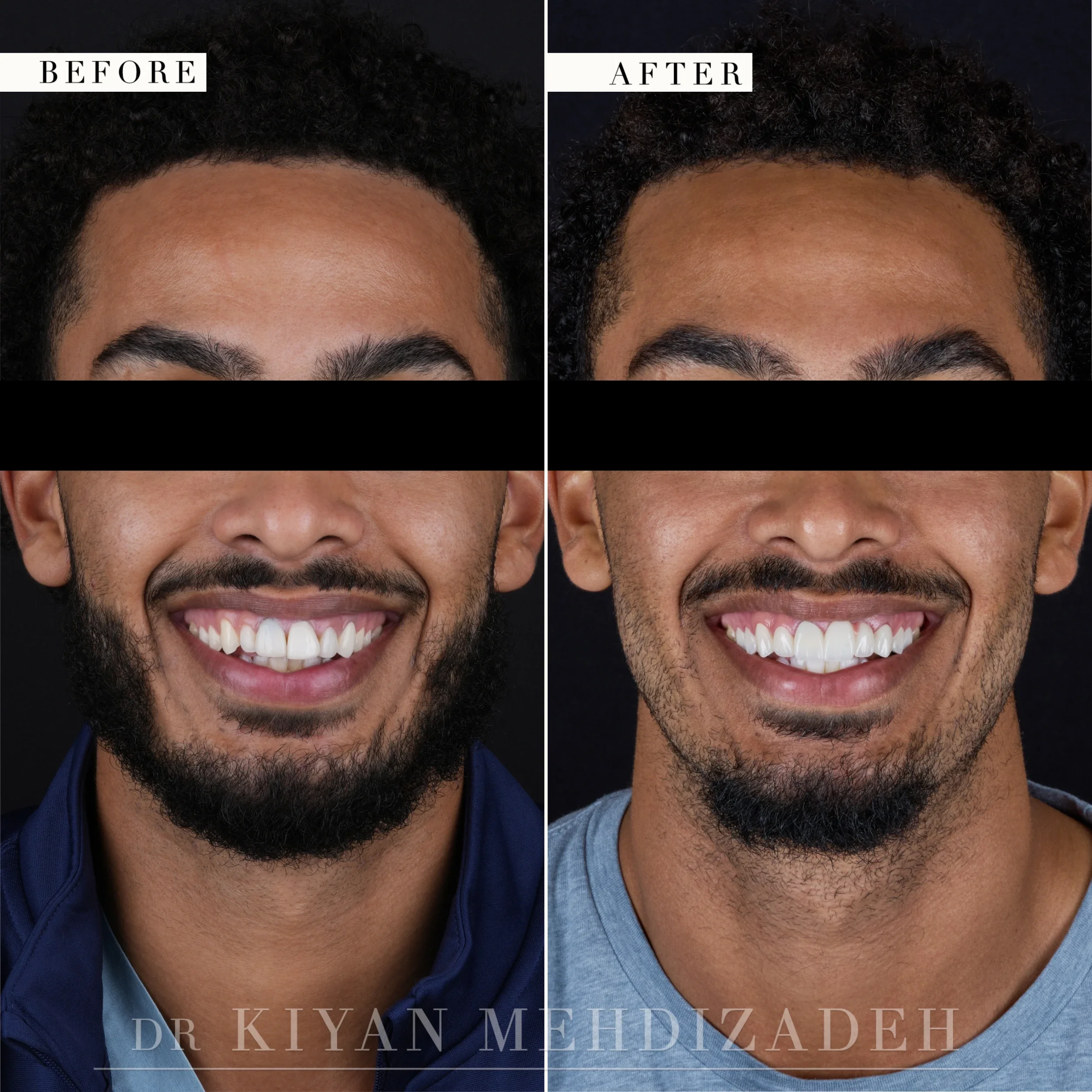 Full-face portrait after a pink porcelain bridge and veneers restored the smile, Beverly Hills