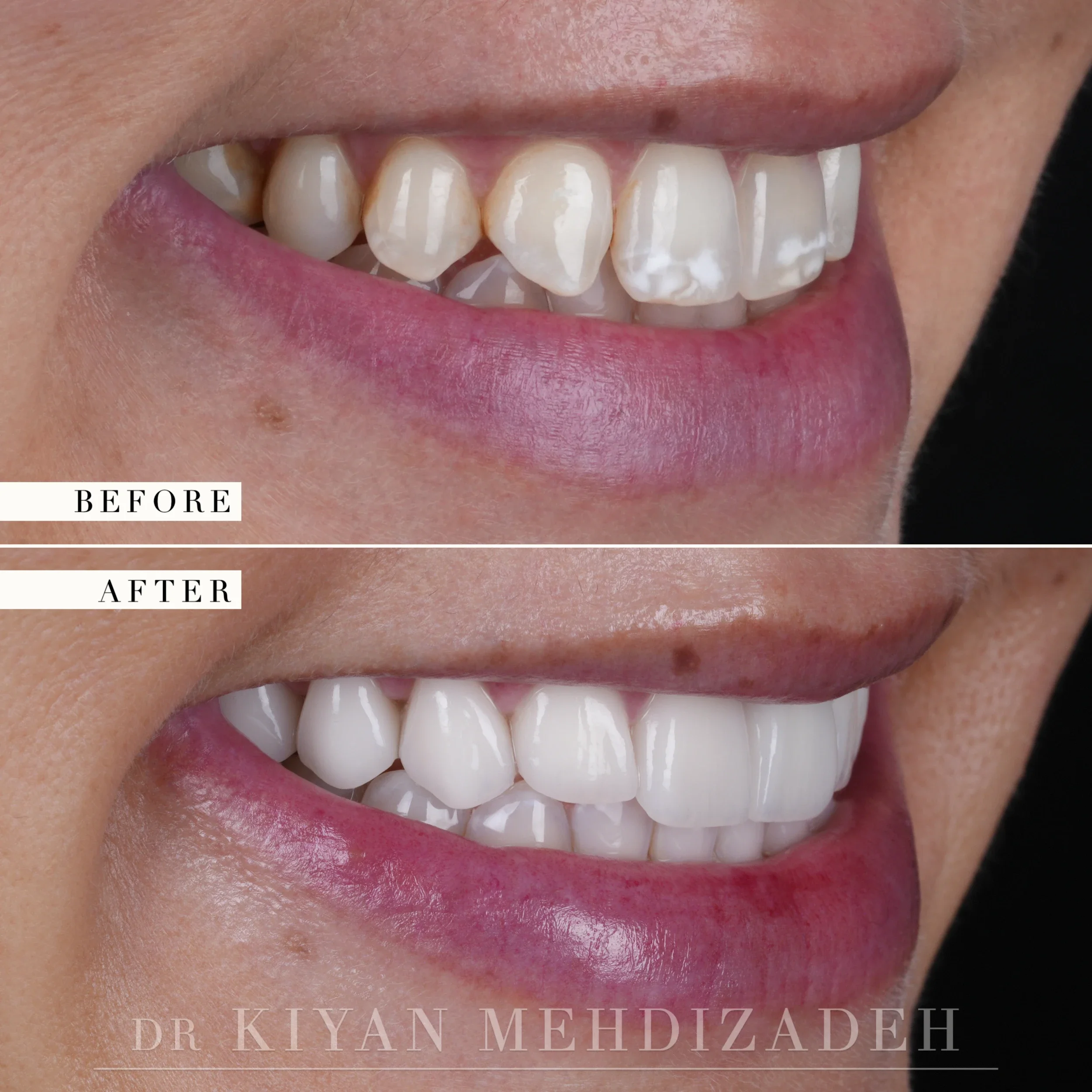 Right lateral view of the smile, before and after