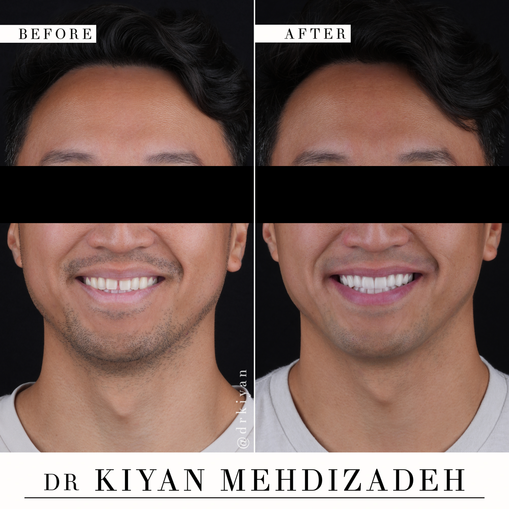 Before and after diastema closure with porcelain veneers &mdash; full portrait view