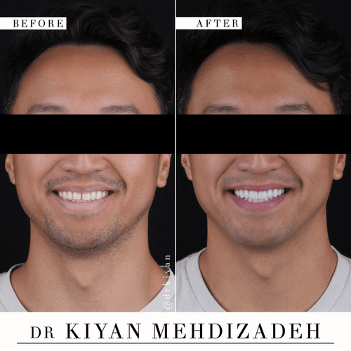 Diastema closure with porcelain veneers before and after &mdash; Case Study 06
