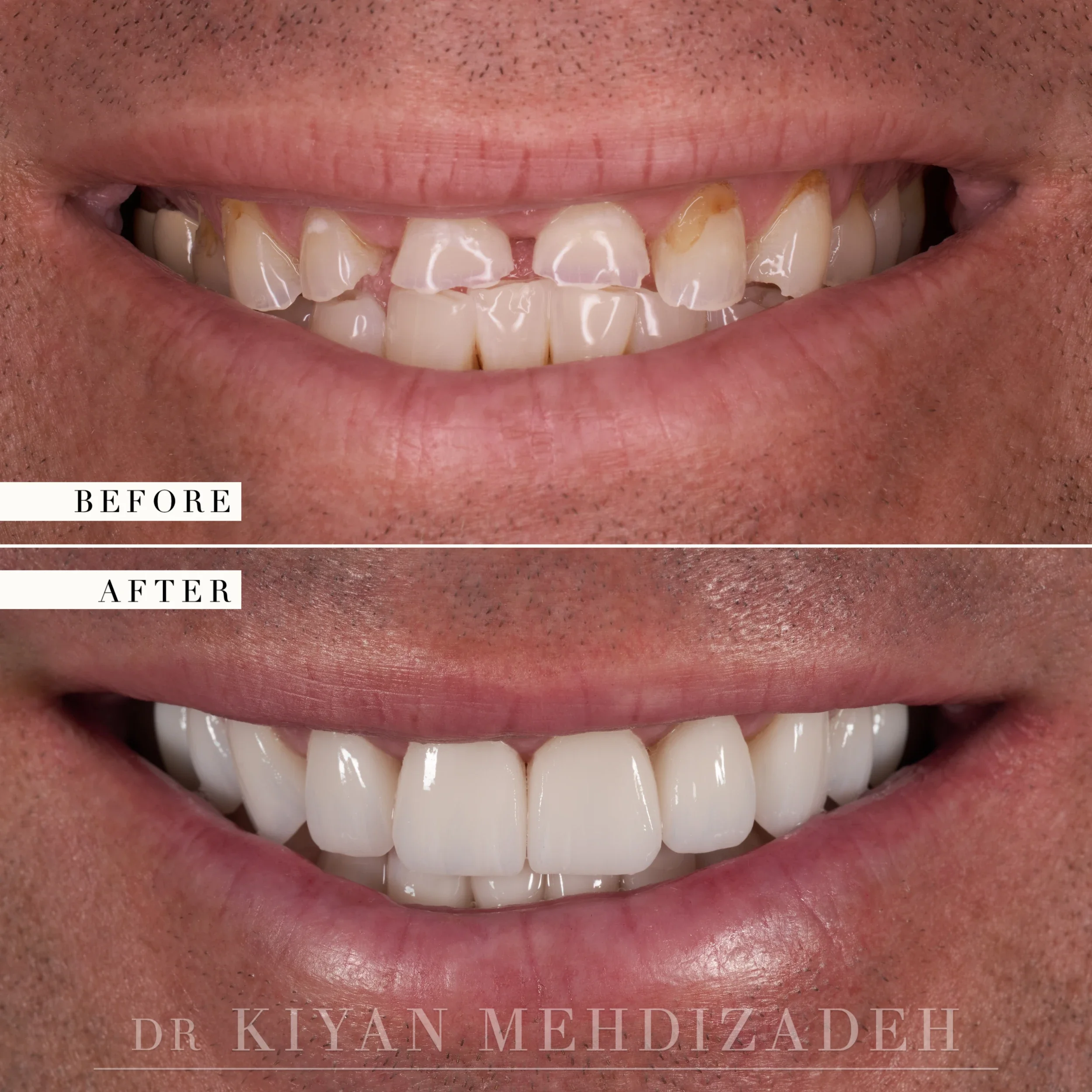 Before and after: severe grinding wear on the upper and lower teeth restored with twenty-eight individual ceramic units, Beverly Hills