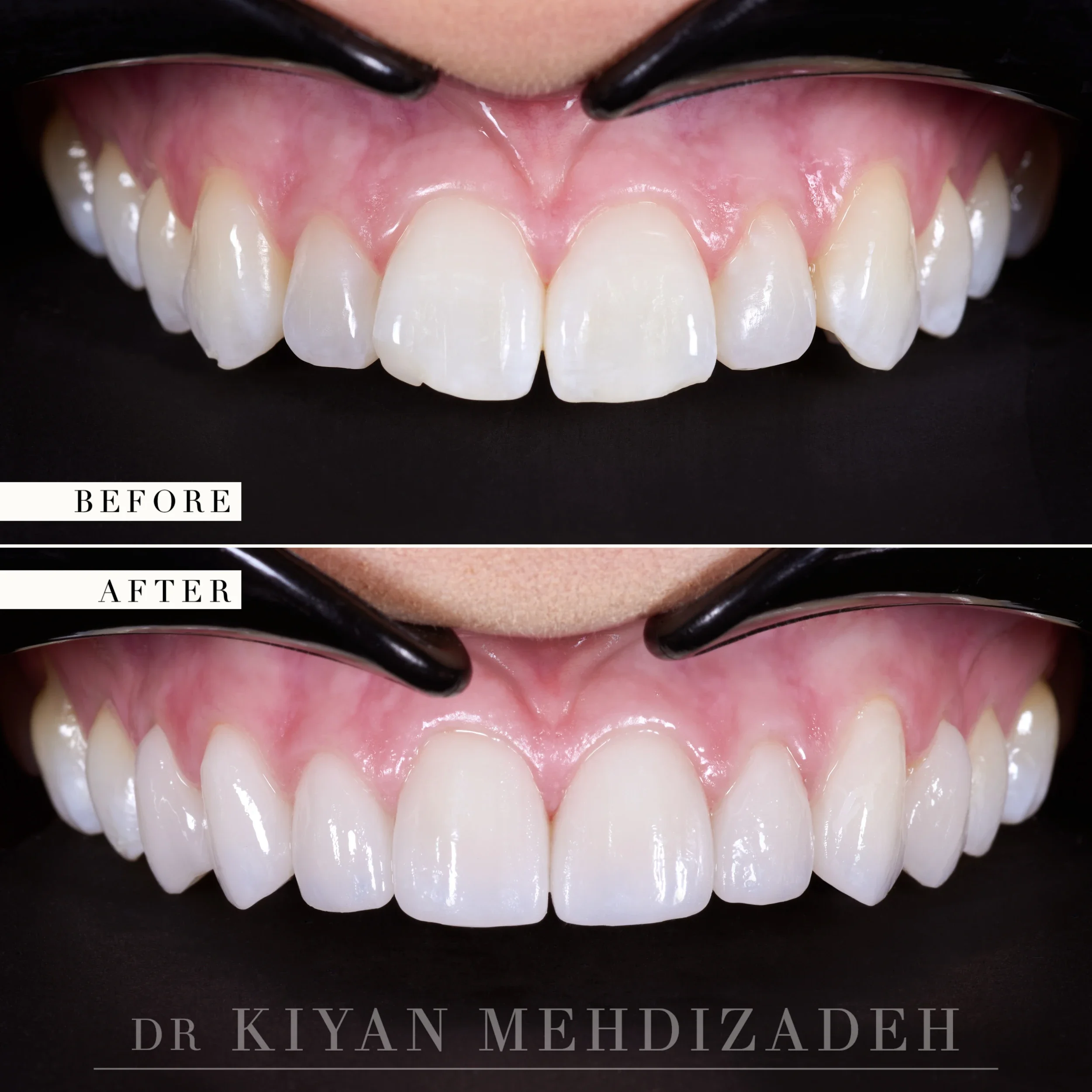 Retracted view of the upper arch, before and after