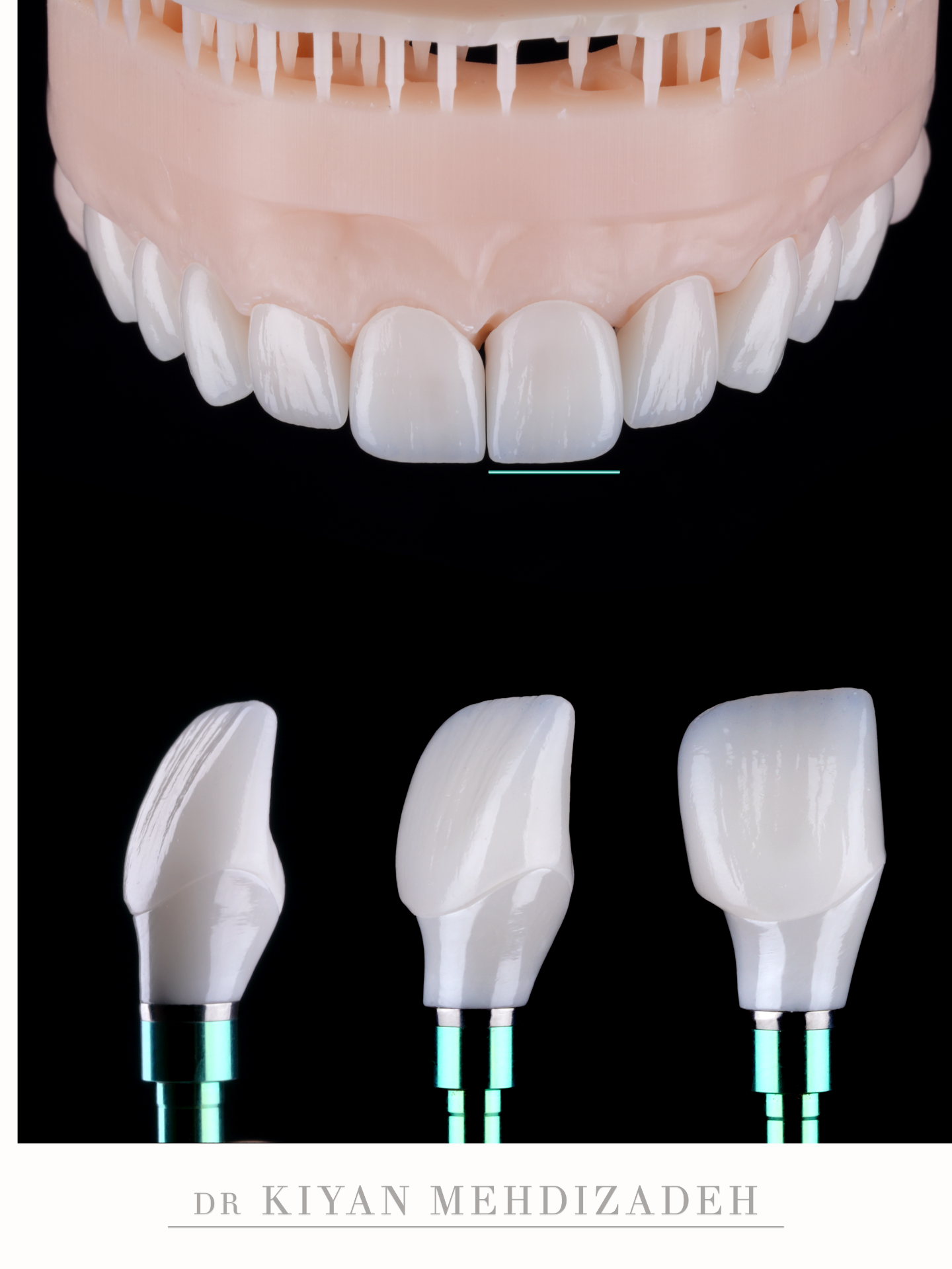 Laboratory work for the case: the implant crown and porcelain veneers built together on the model before delivery