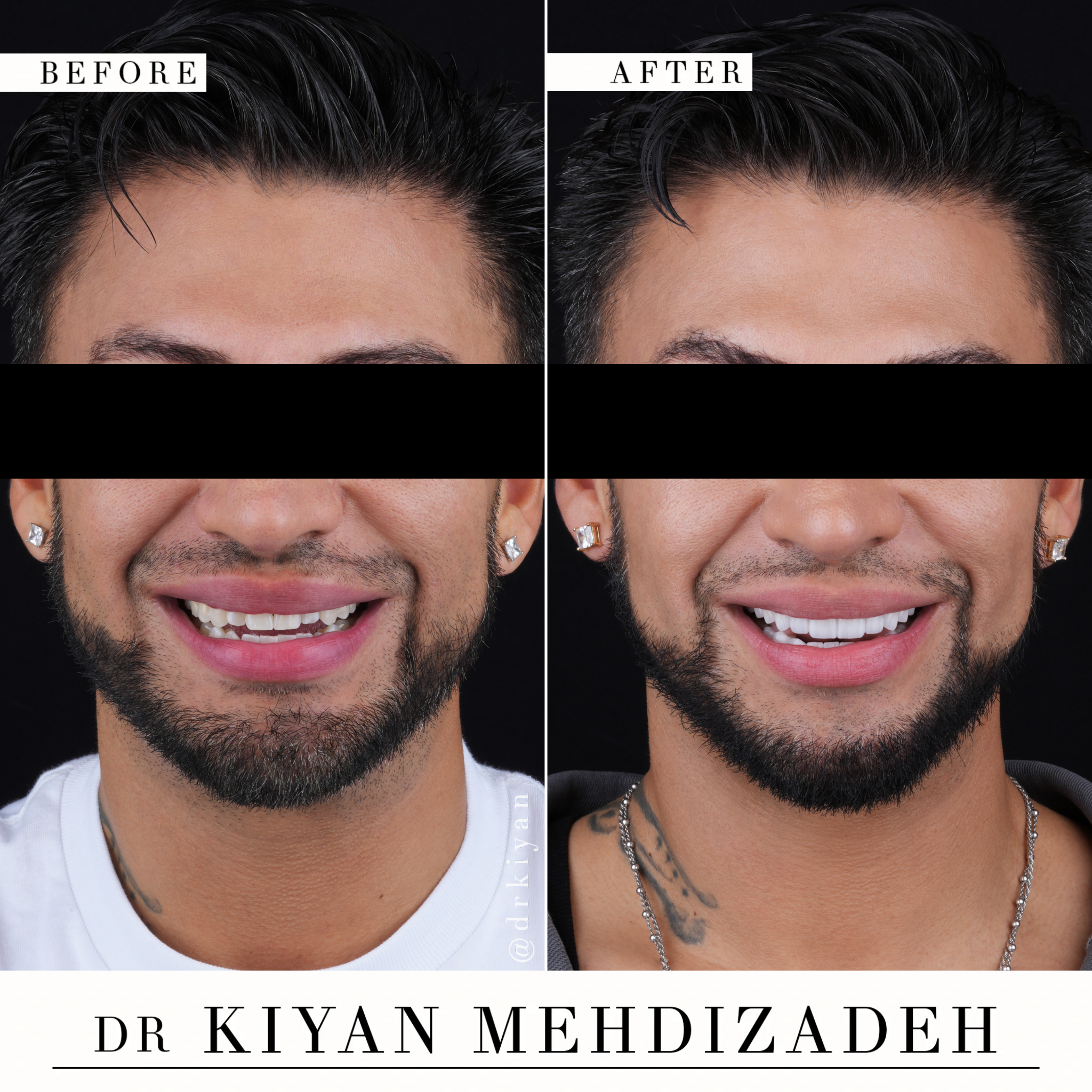 Before and after full mouth veneers correcting low tooth display, crowding, and wear &ndash; smile comparison