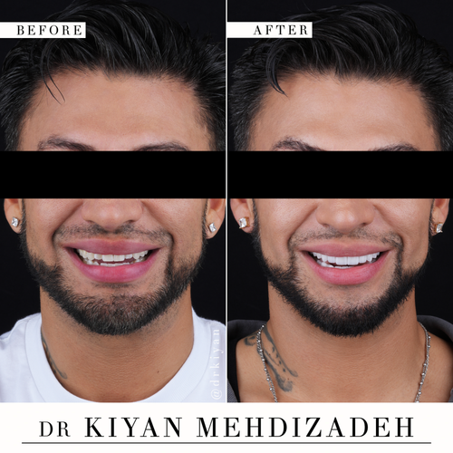 Full mouth porcelain veneers before and after &mdash; Case Study 17