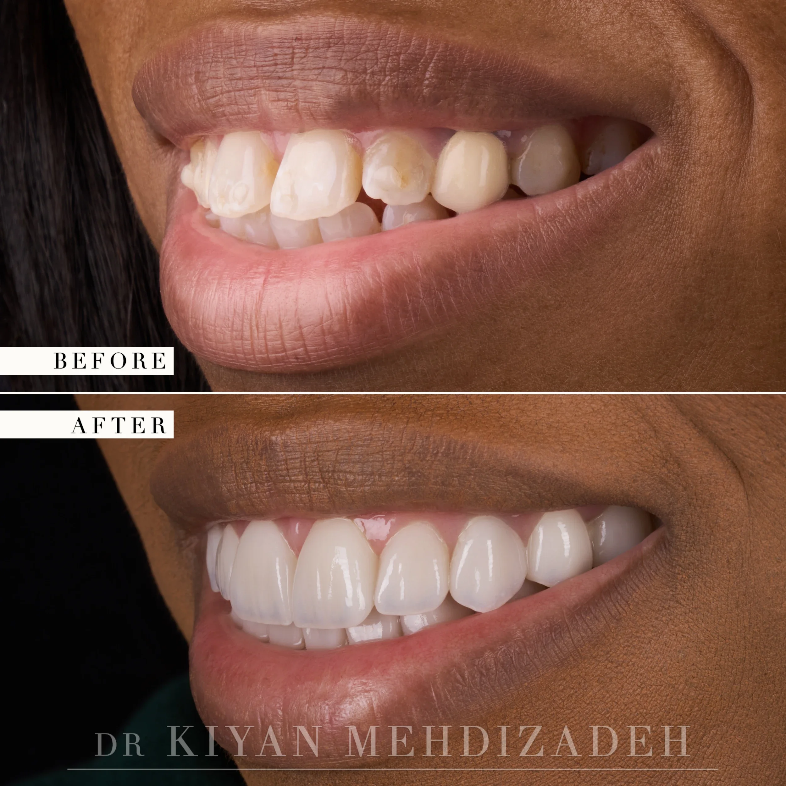 Right lateral view after veneers corrected flaring and discoloration