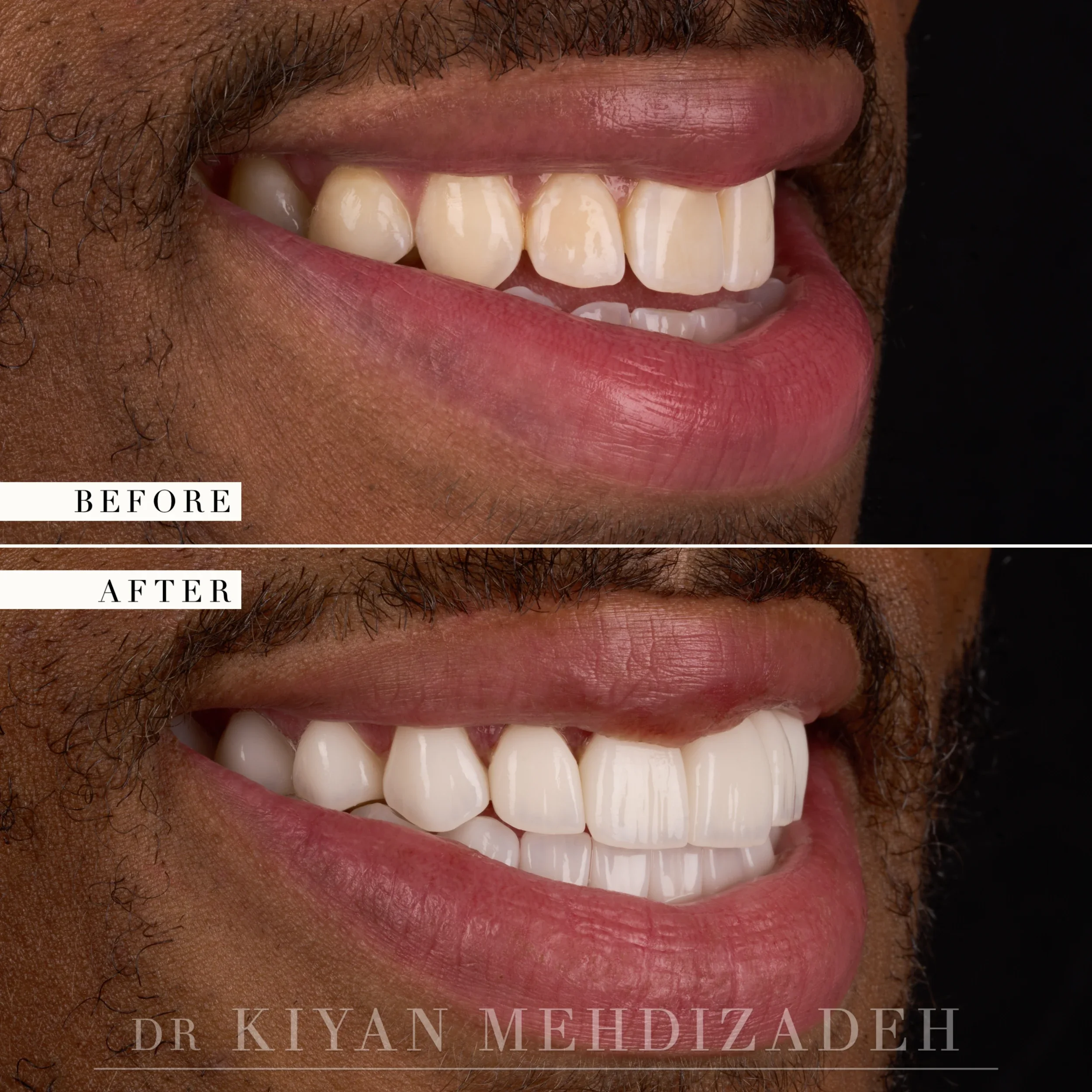 Lateral view after full-mouth veneers rebuilt the bite