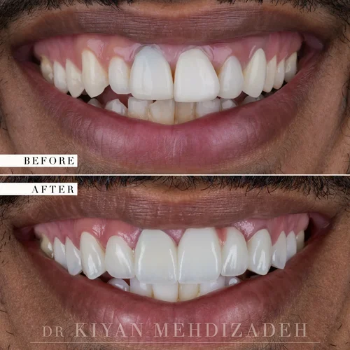 Pink Porcelain Bridge & Veneers before and after - Case Study 19 - Dr. Kiyan Mehdizadeh