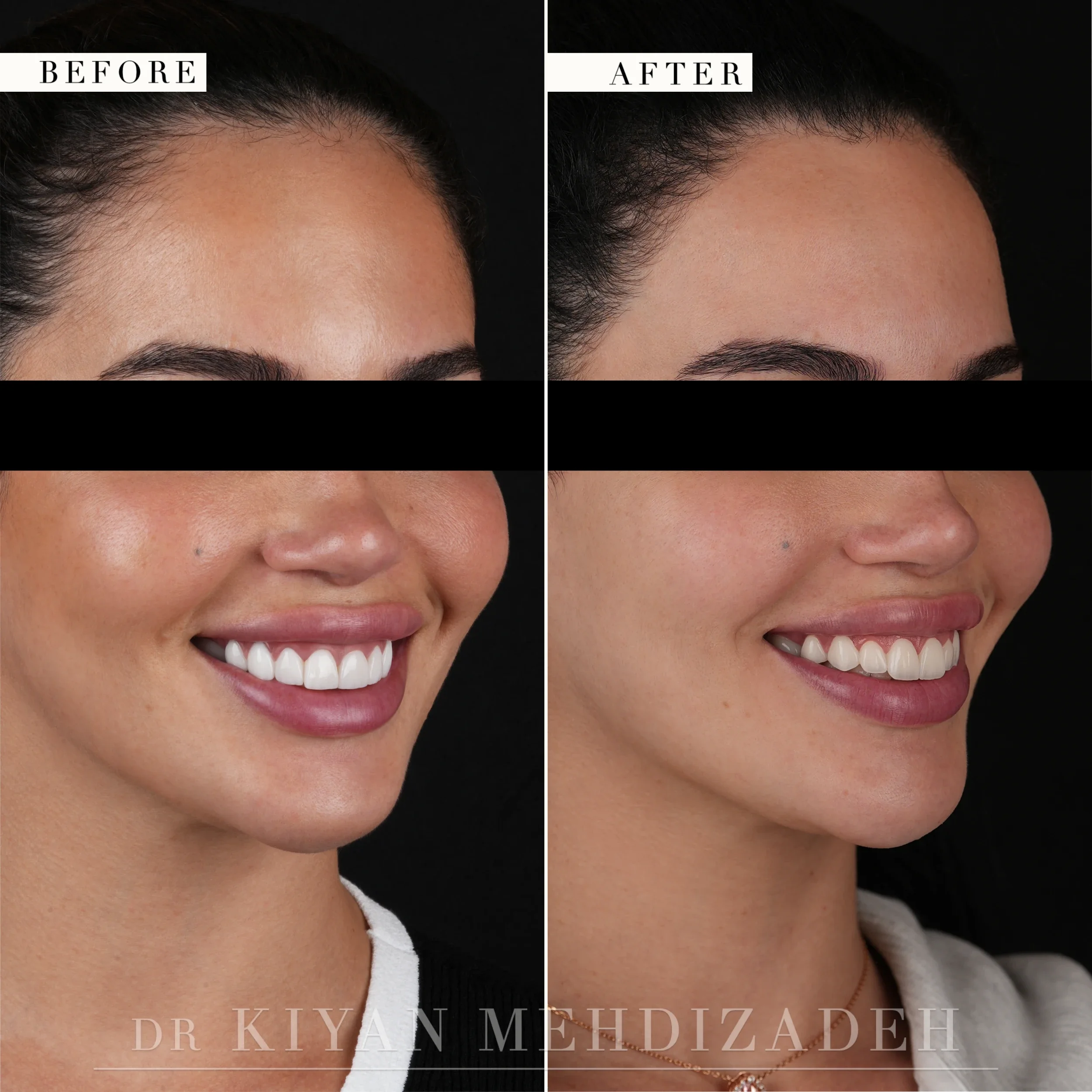 Before and after smile redesign - full-face portrait, three-quarter angle