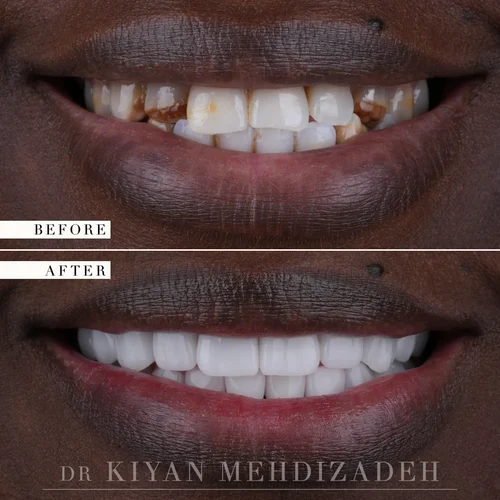 Fluorosis treatment with porcelain veneers and dental implant &mdash; Case Study 16