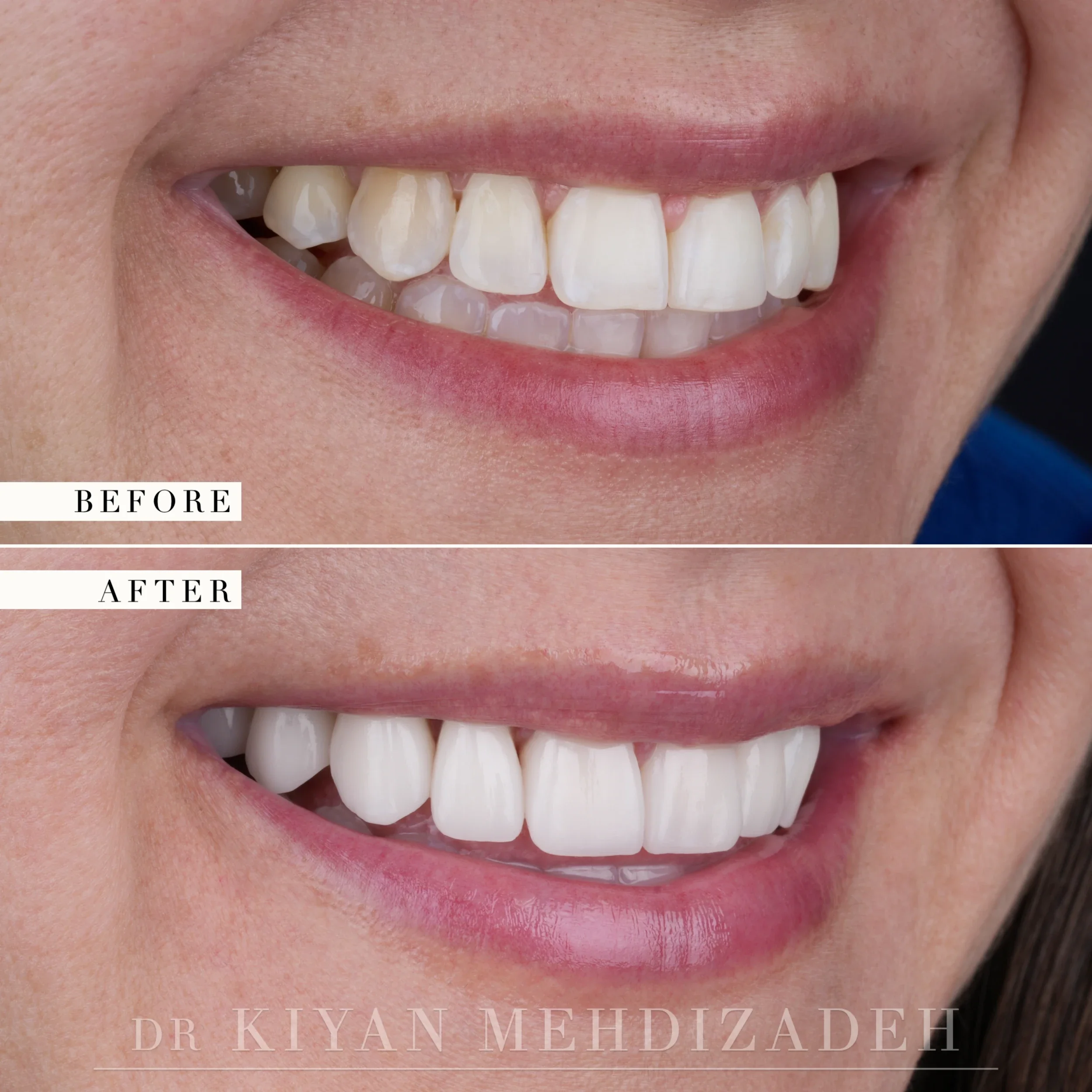 Right side before and after: mismatched tooth shades and irregular edges restored to uniform porcelain veneers, Beverly Hills